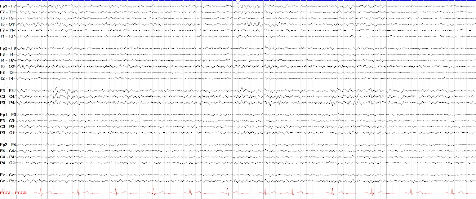 RMTD I