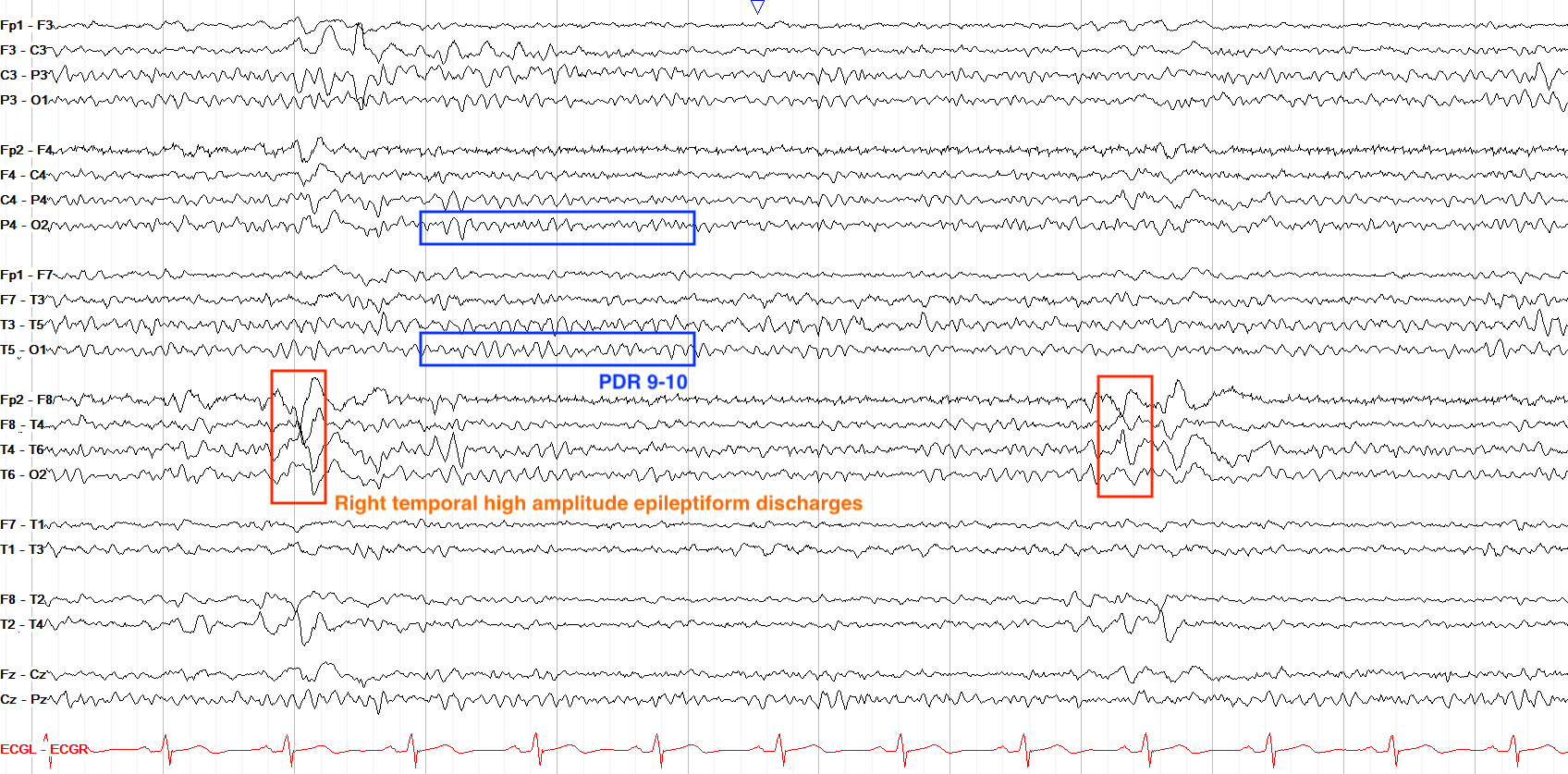 Right temporal sharps annotated