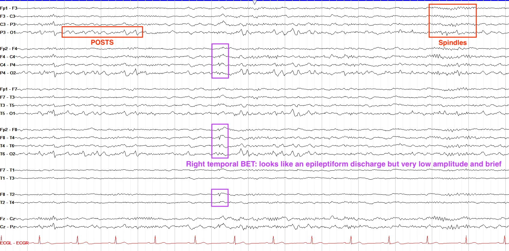 Right posterior BET