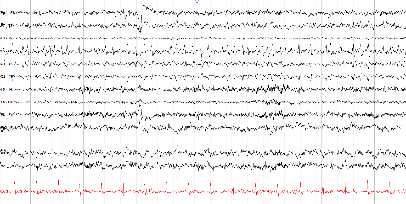 Lambda Waves (circumferential)