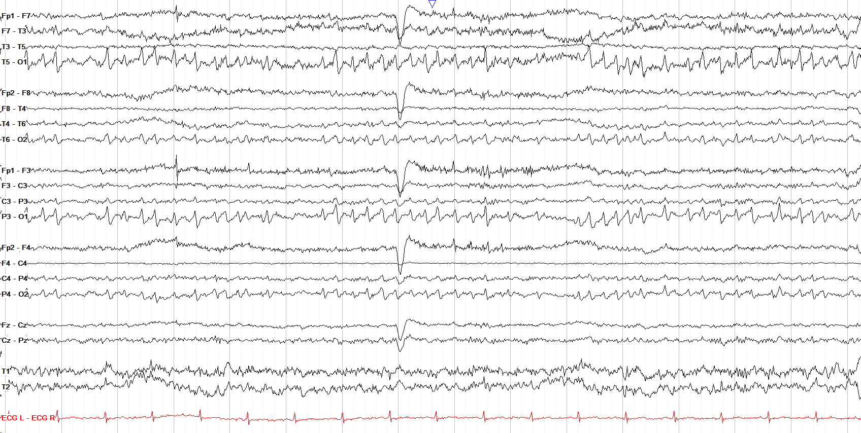 Lambda waves