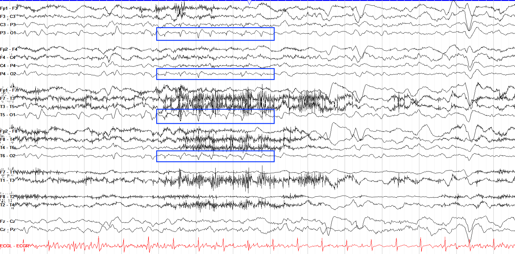 Bioccipital discharges