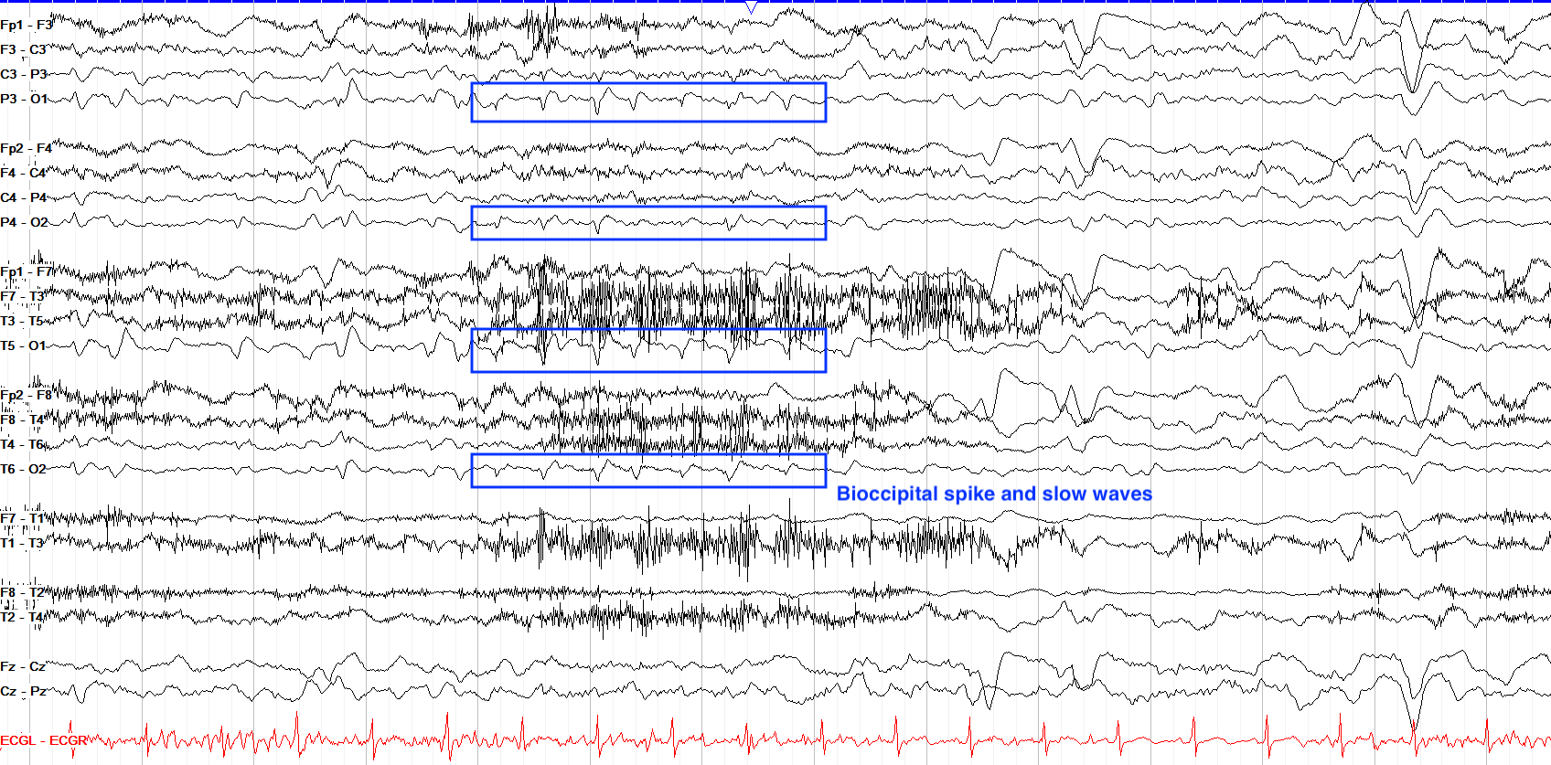 Bioccipital discharges annotated