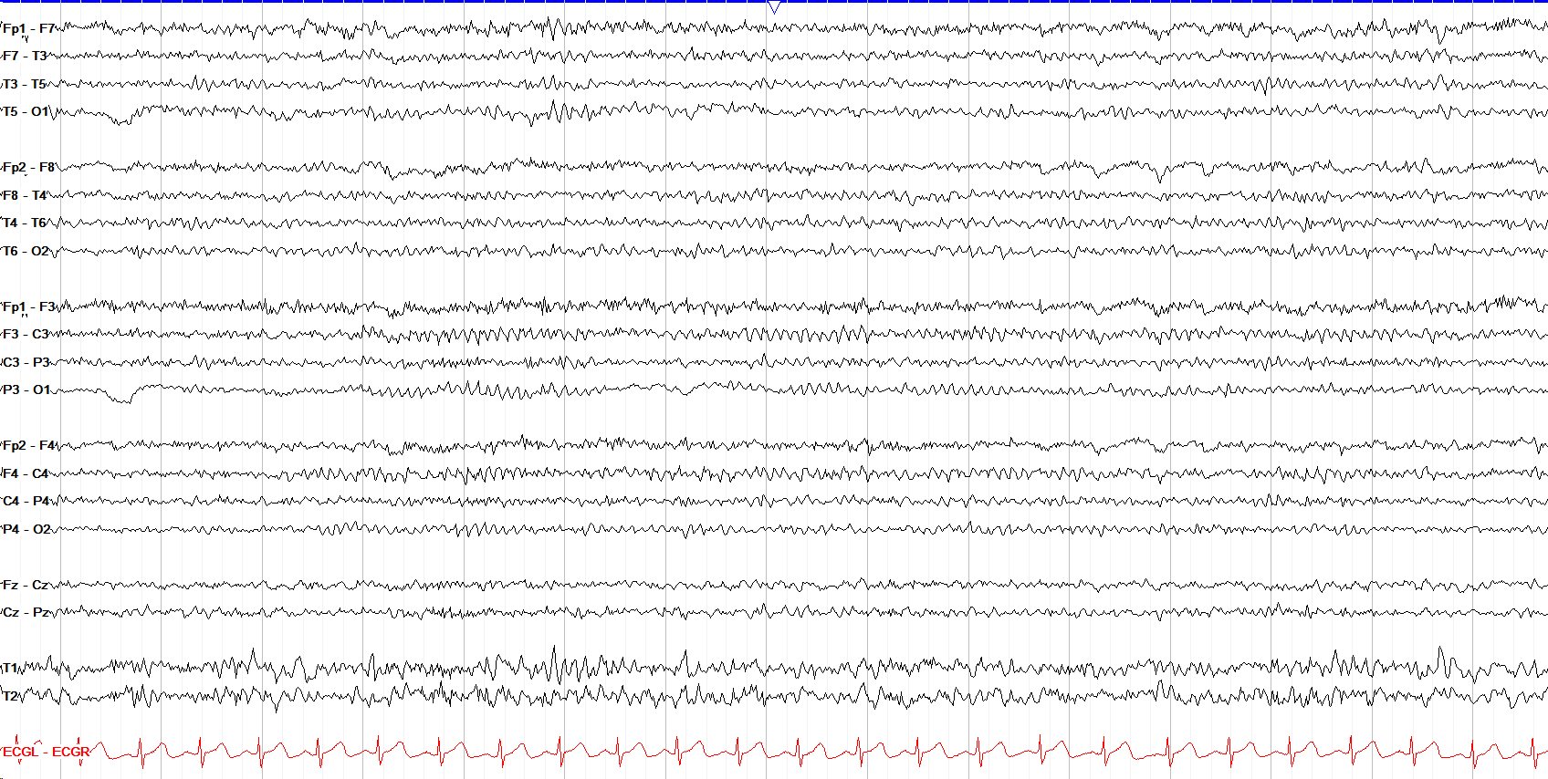 Mu rhythm