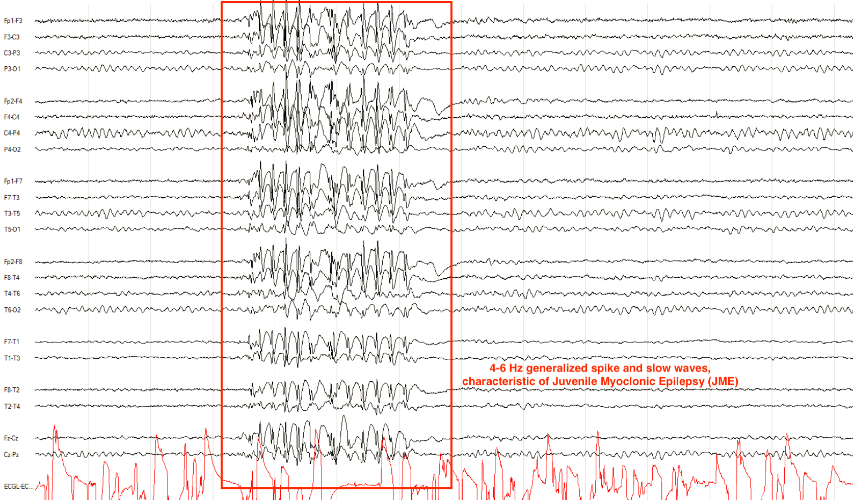 4-6 Hz generalized spike and slow waves characteristic of JME