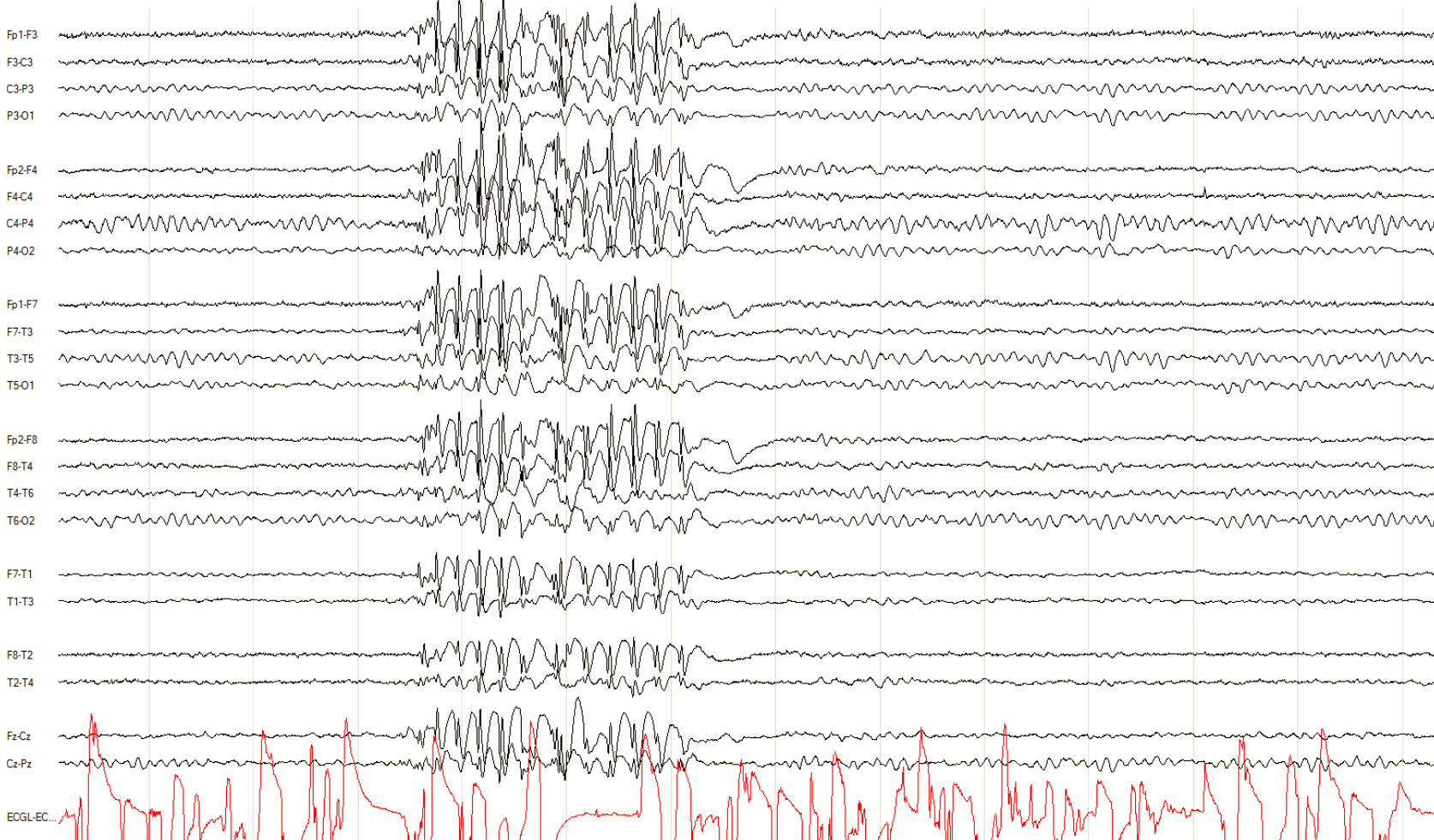 Juvenile myoclonic epilepsy