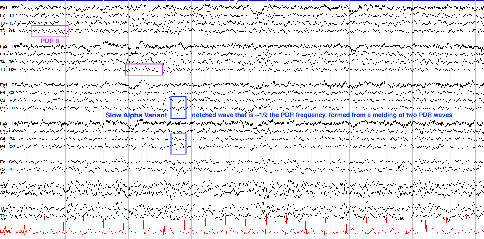 posterior slow waves of youth variant