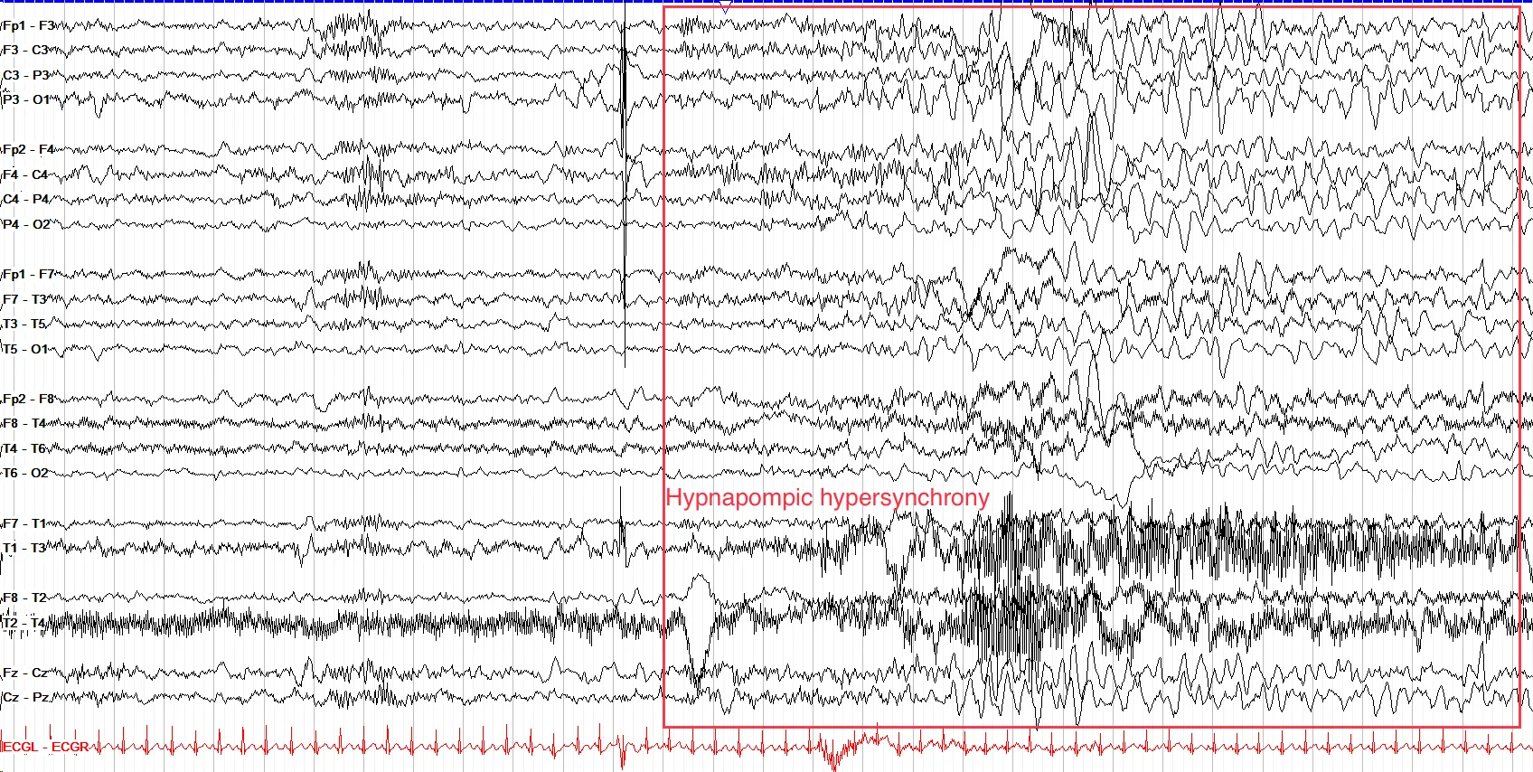 Hypnopompic Hypersynchrony