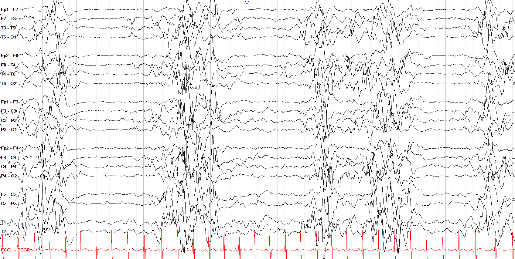 Ohtahara syndrome
