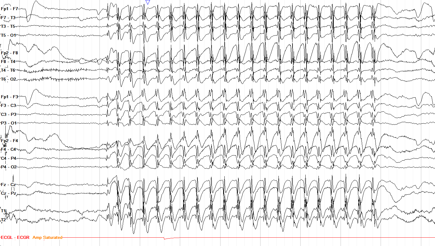 Absence epilepsy