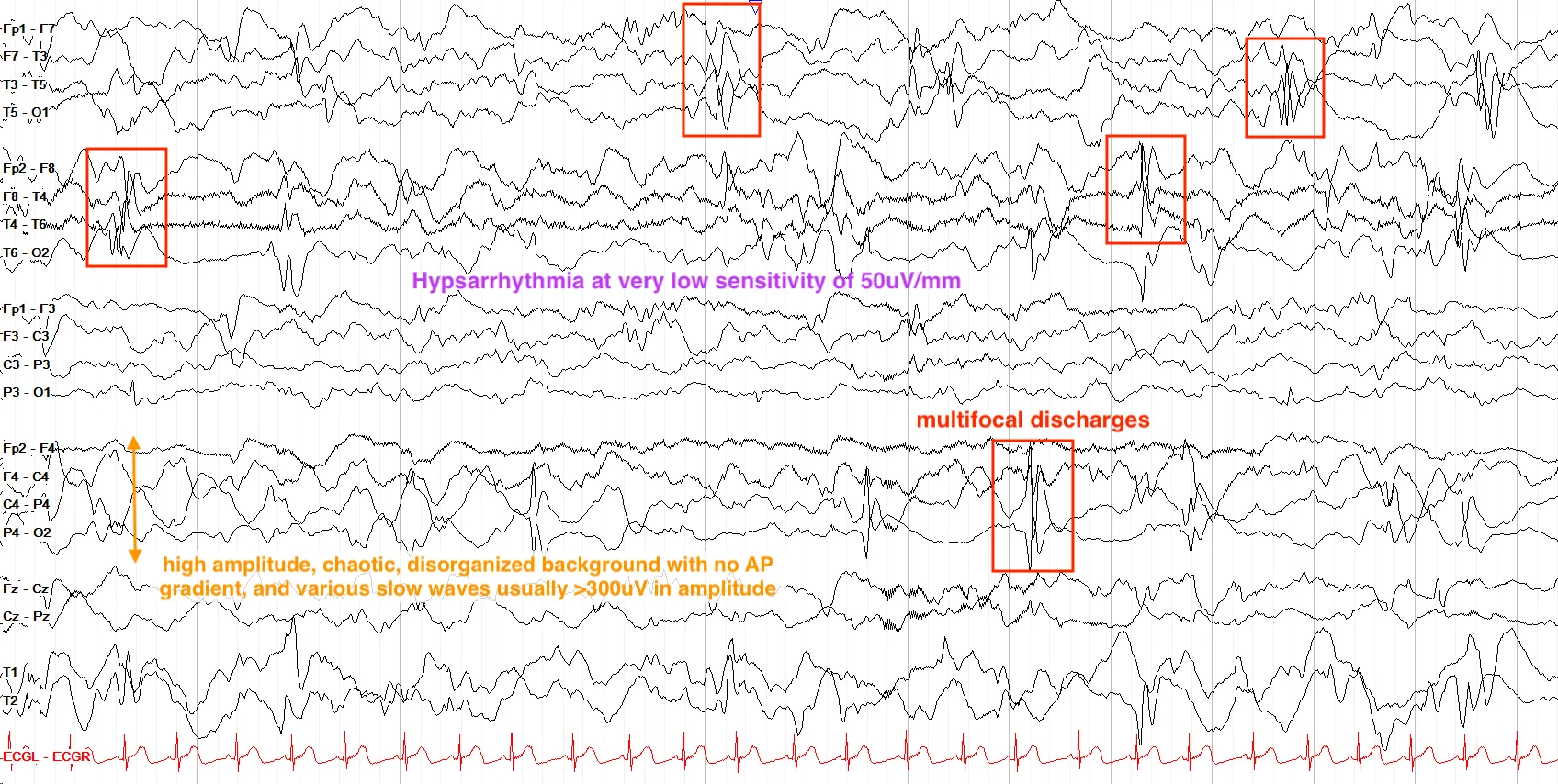 hypsarrhythmia at 50uV