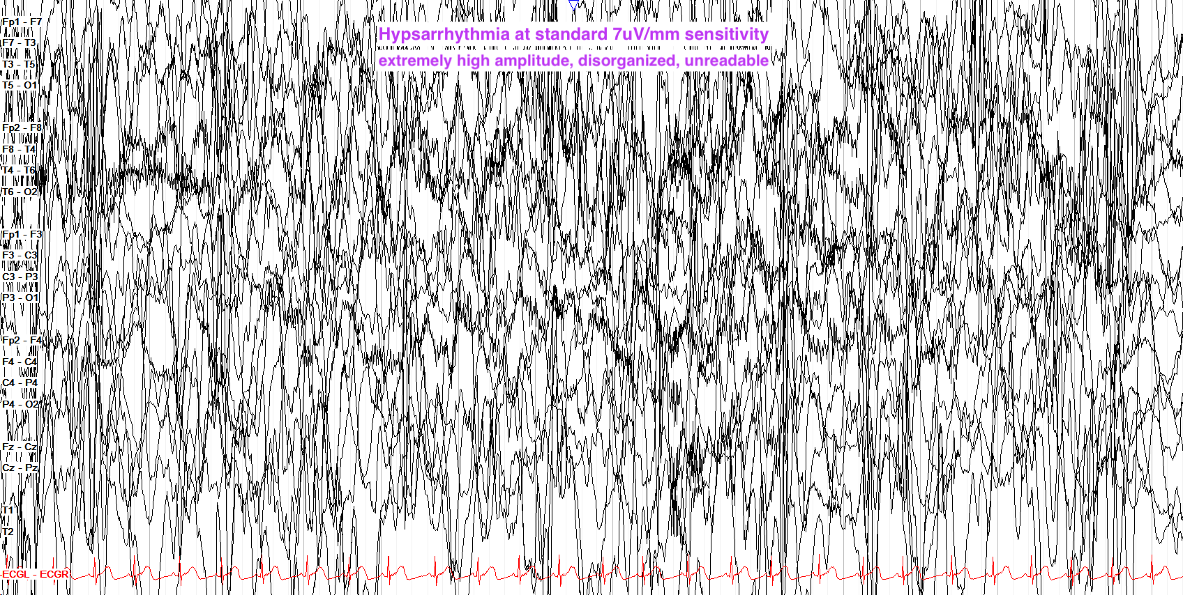 hypsarrhythmia at 7uV