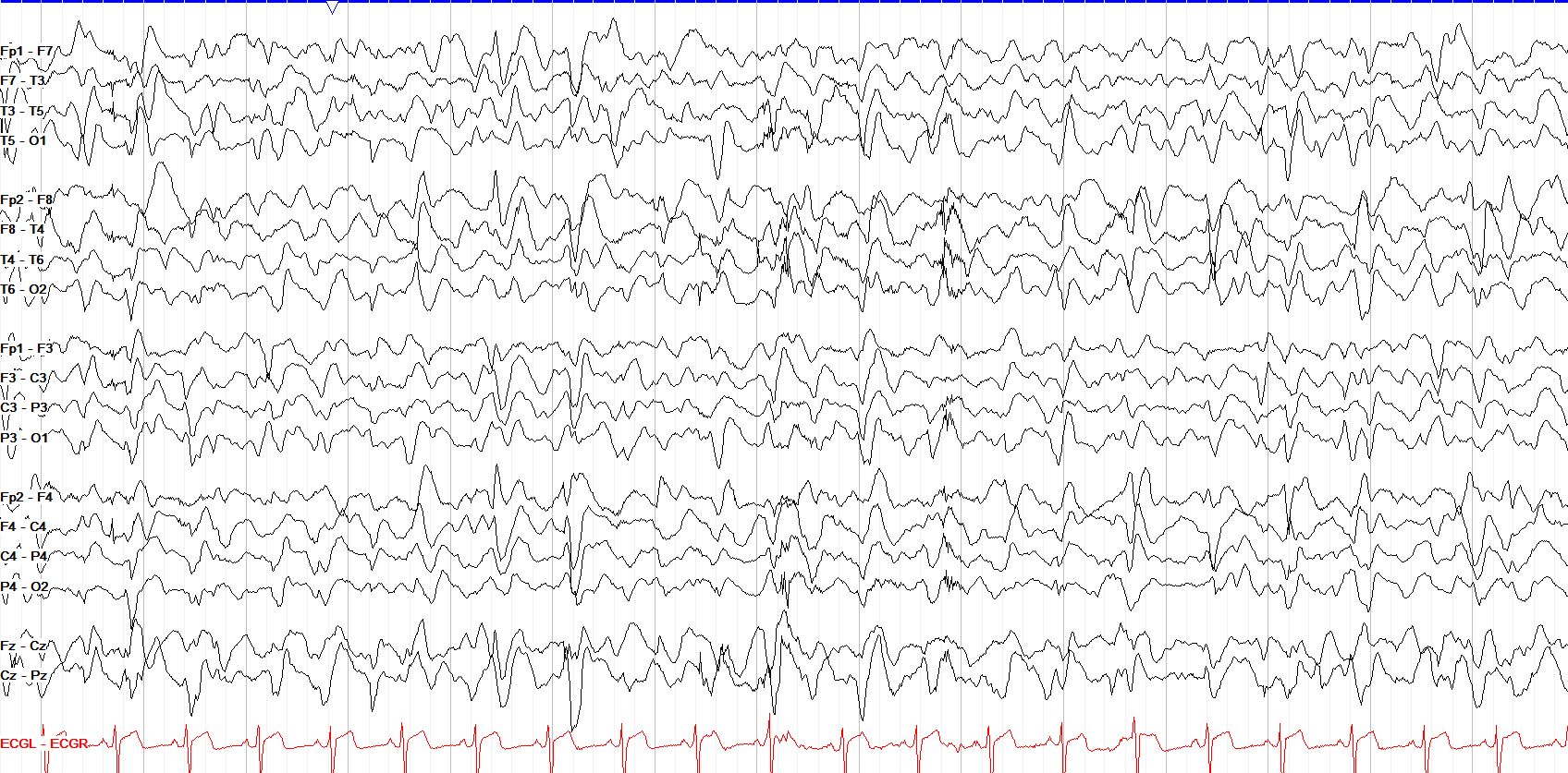 Lennox Gastaut syndrome