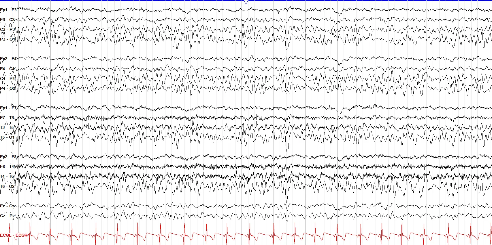 posterior slow waves of youth
