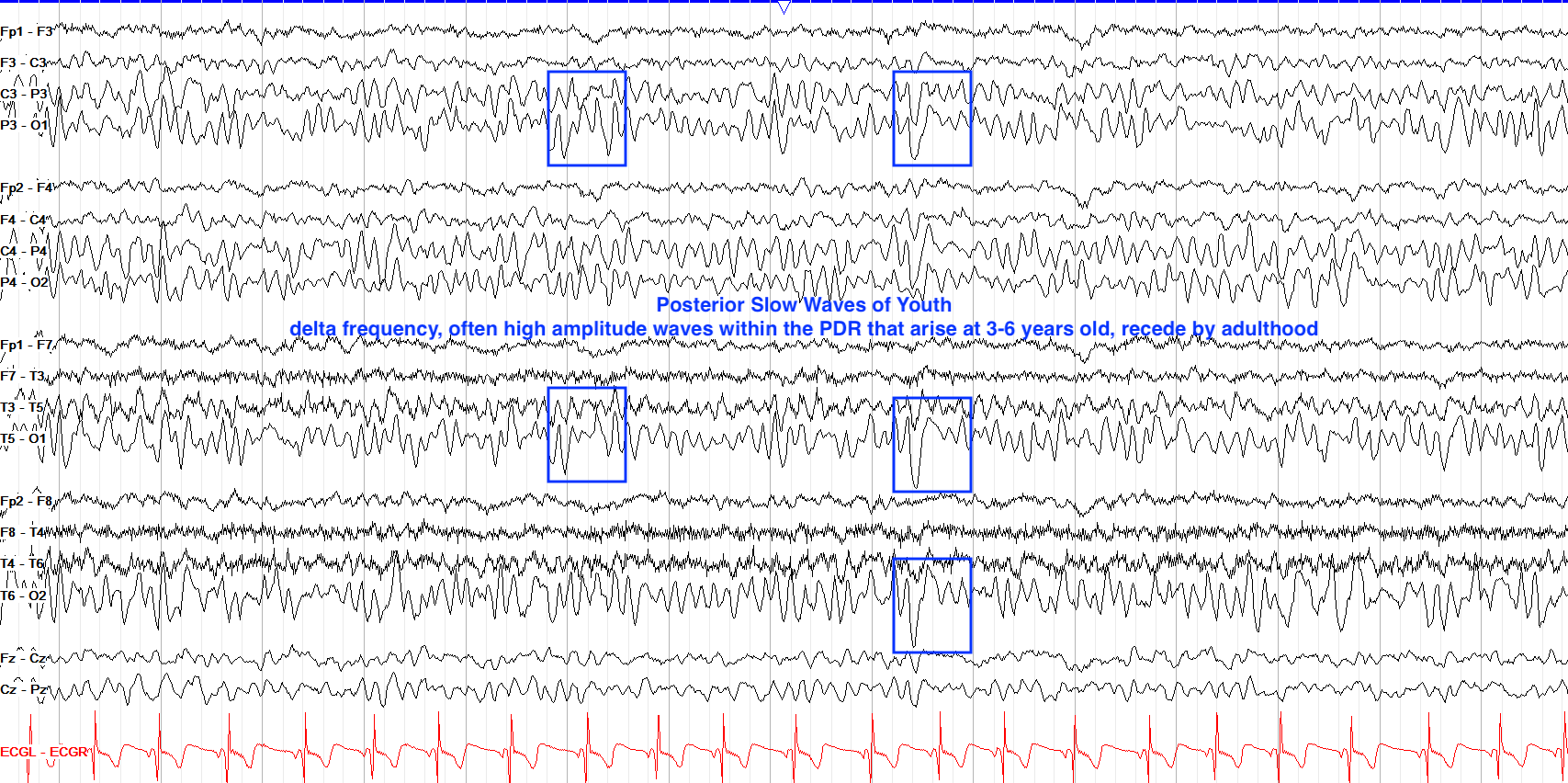 posterior slow waves of youth