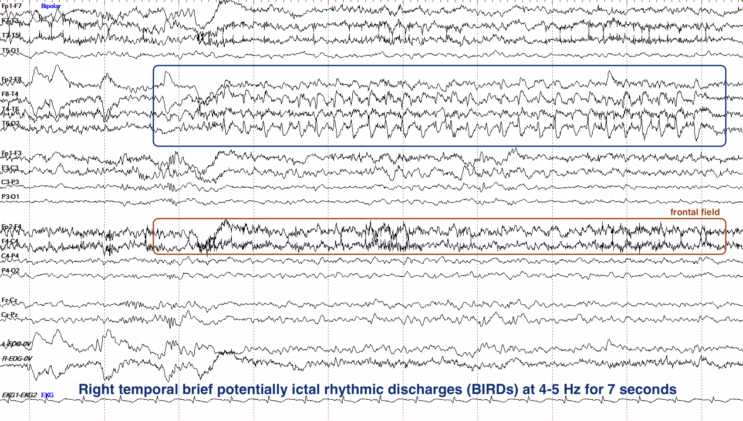 Right temporal brief potentially ictal rhythmic discharges (BIRDs) at 4-5 Hz for 7 seconds, with field into the right frontal region