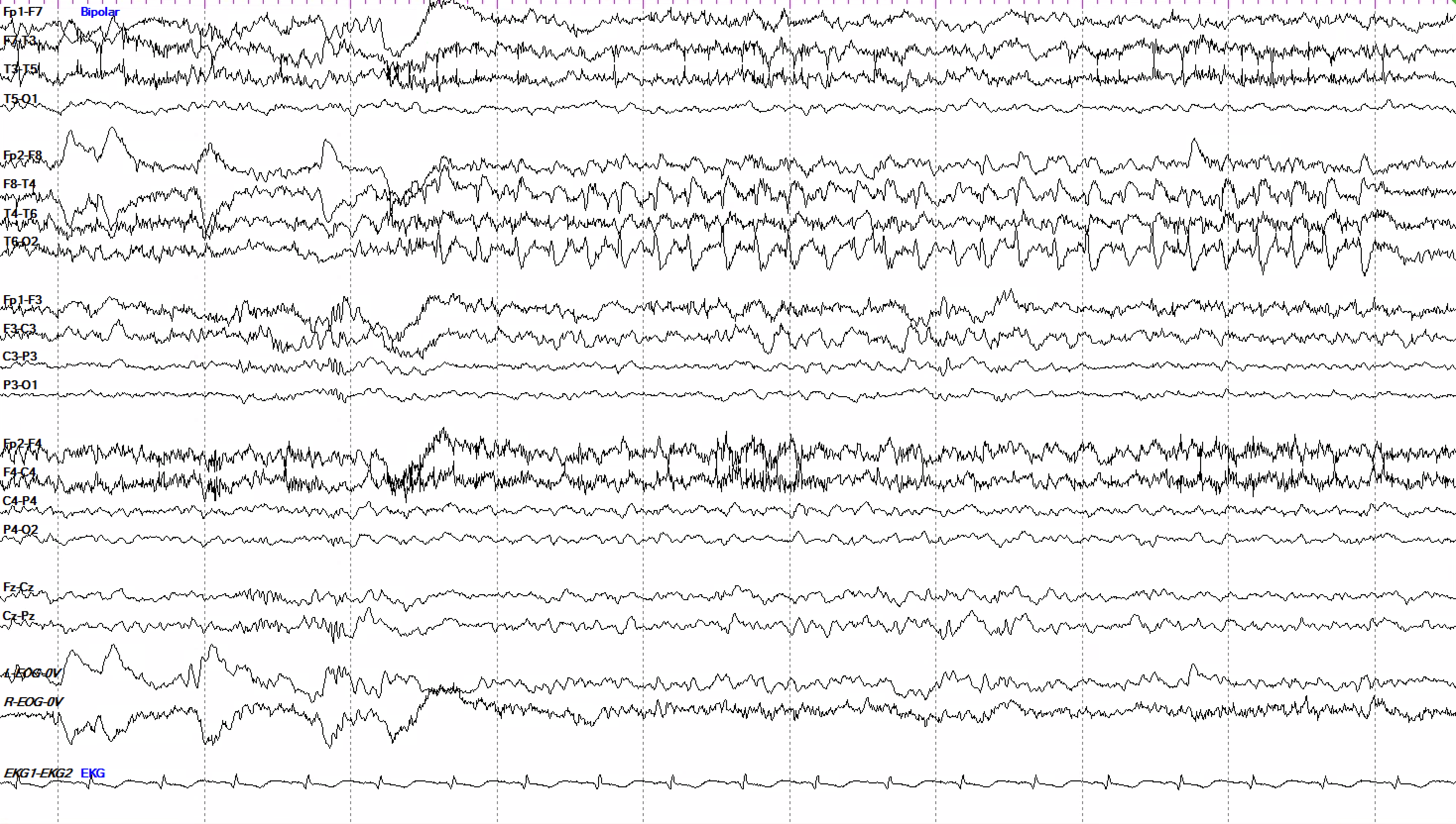 Right temporal BIRDs at 4-5 Hz