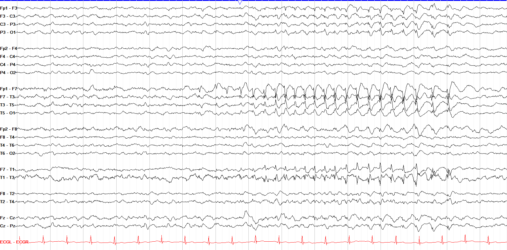 Brief ~3 Hz left anterior temporal spike-and-wave (not a BIRD)