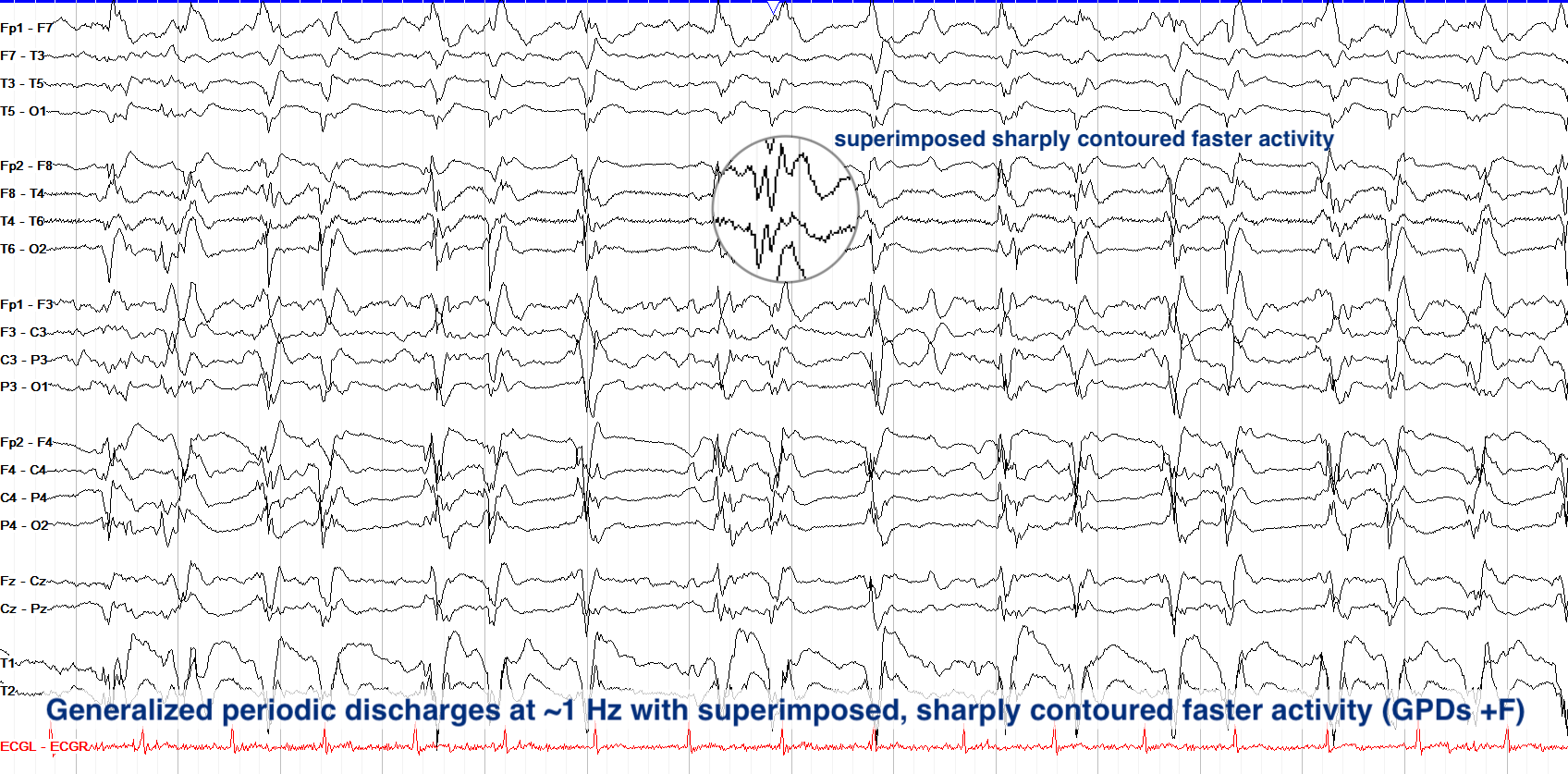 Generalized periodic discharges at ~1 Hz with superimposed, sharply contoured faster activity (GPDs +F)