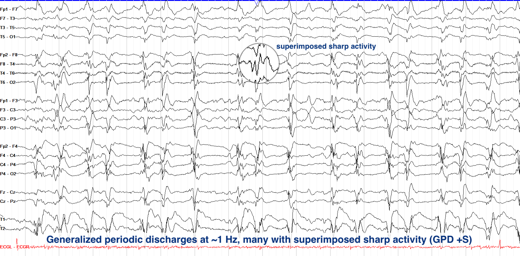 Generalized periodic discharges at ~1 Hz with superimposed sharp activity (GPDs +S)