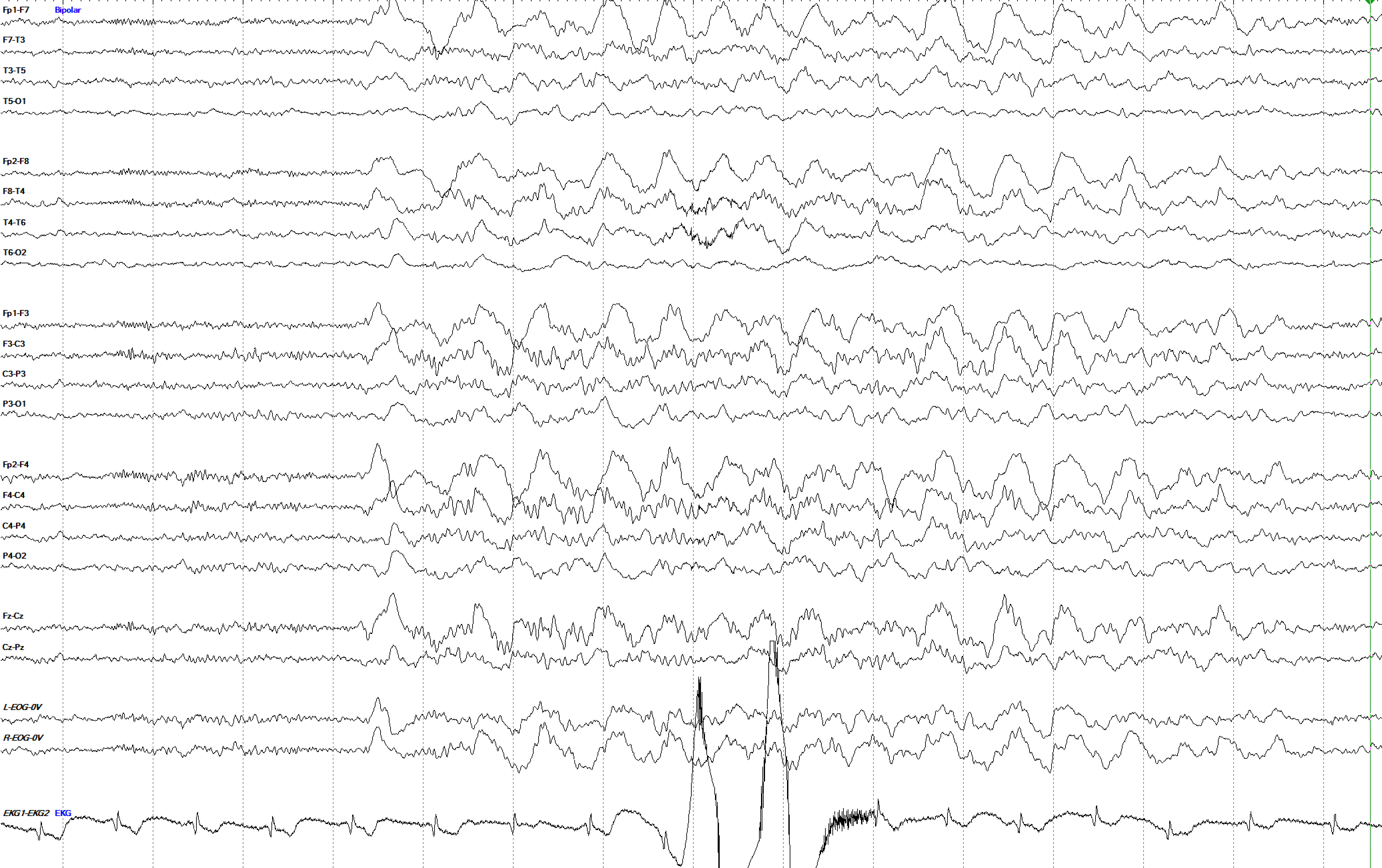 Frontally predominant GRDA at 1.5 Hz