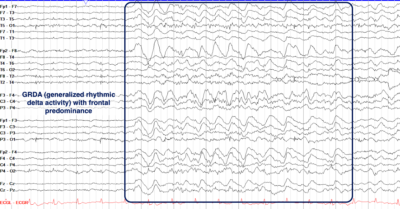 Generalized rhythmic delta activity (GRDA) with frontal predominance