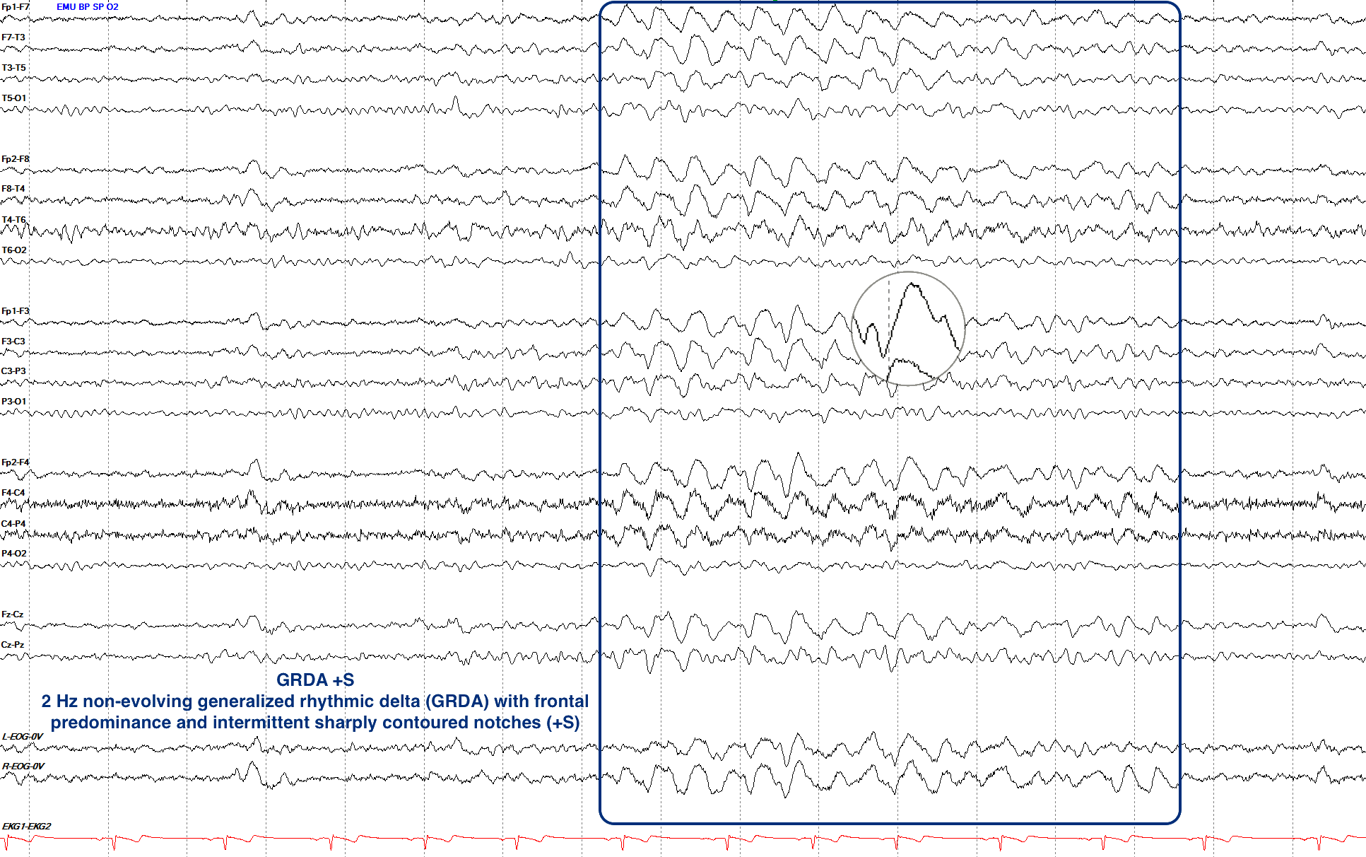 Generalized rhythmic delta activity with superimposed sharp activity (GRDA +S)