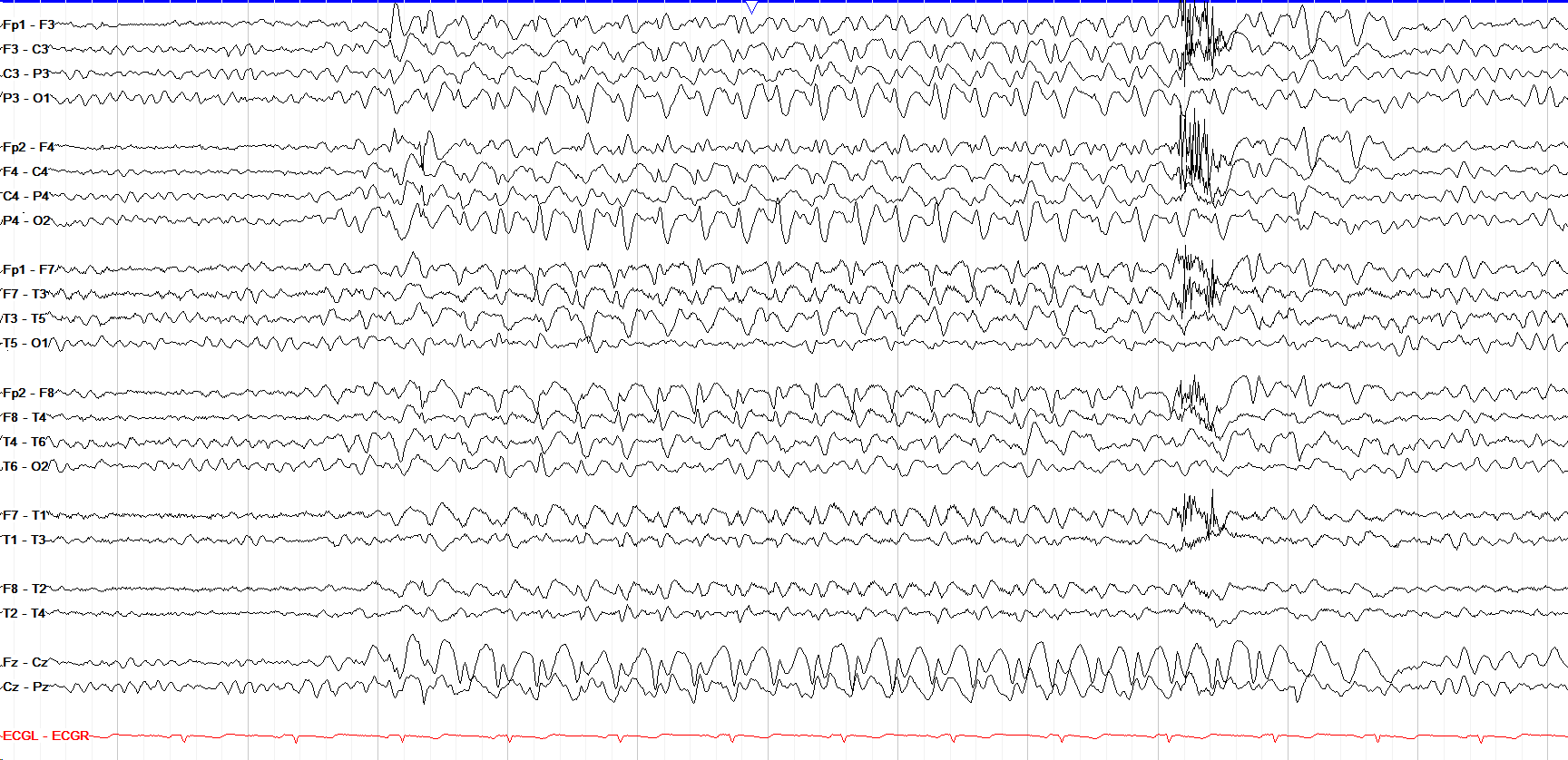 Generalized frontally predominant 3 Hz spike-and-slow-wave