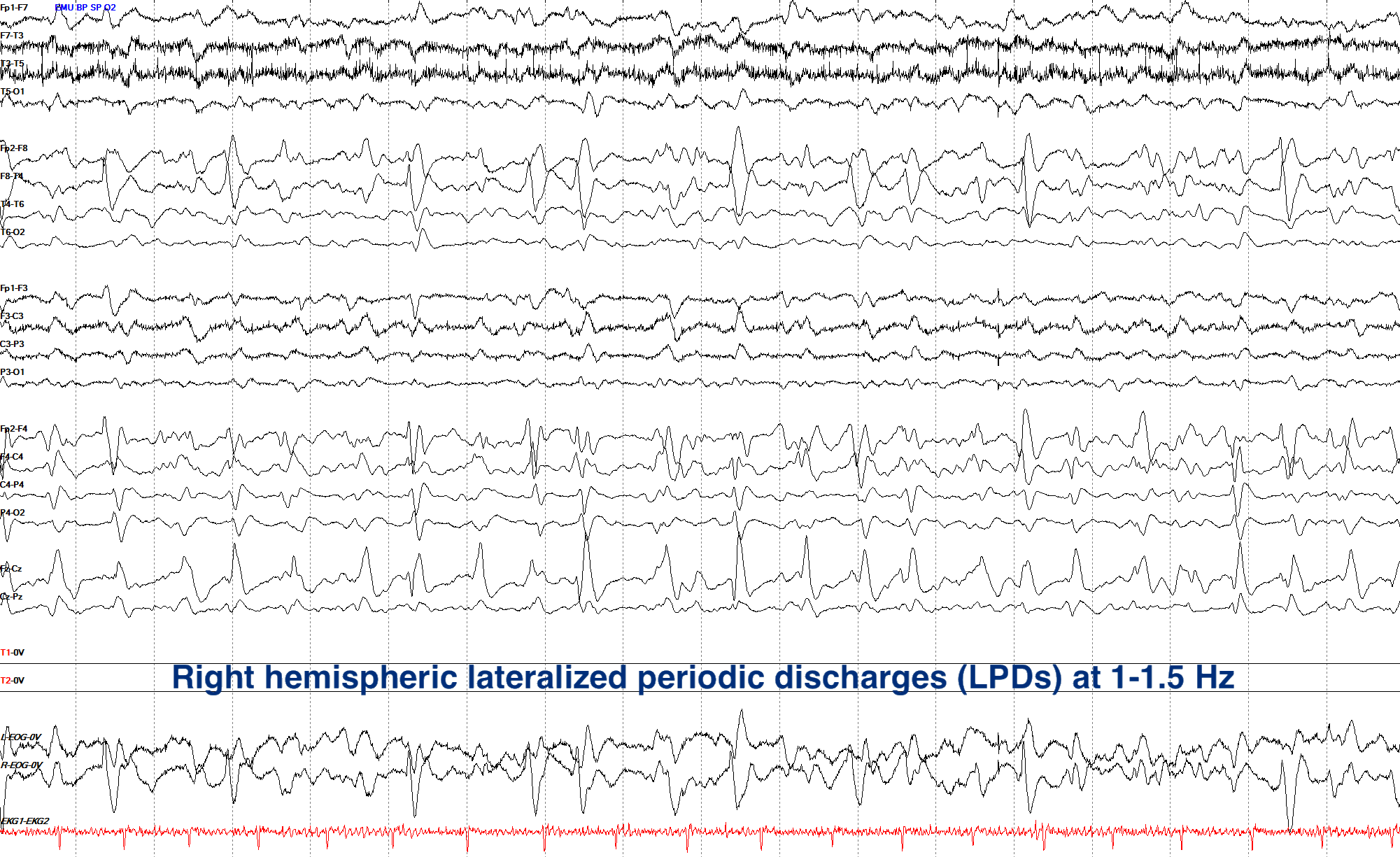 Right hemispheric lateralized periodic discharges (LPDs) at 1-1.5 Hz