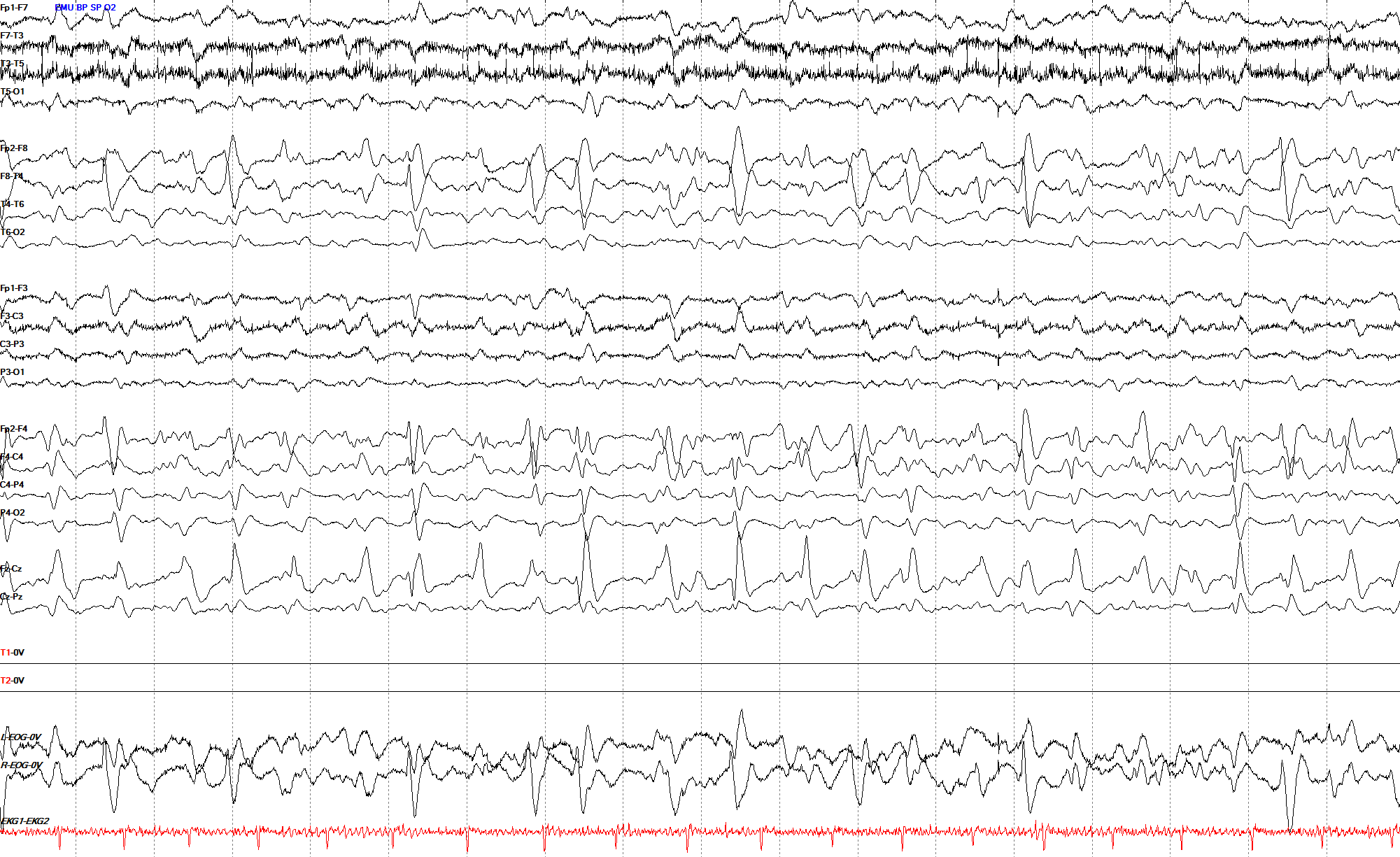 Right hemispheric LPDs at 1-1.5 Hz