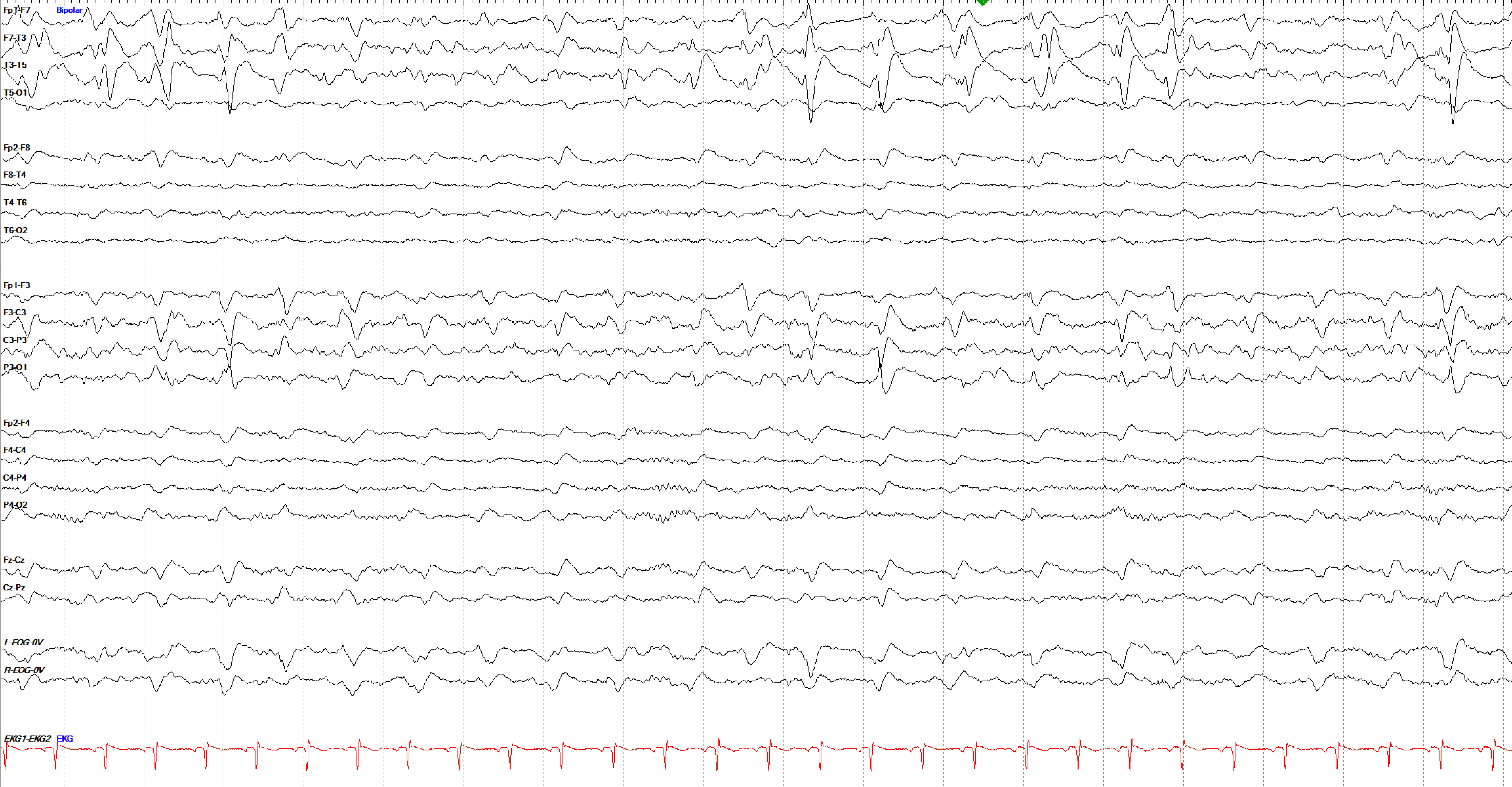 Left temporal LPDs at 1 Hz