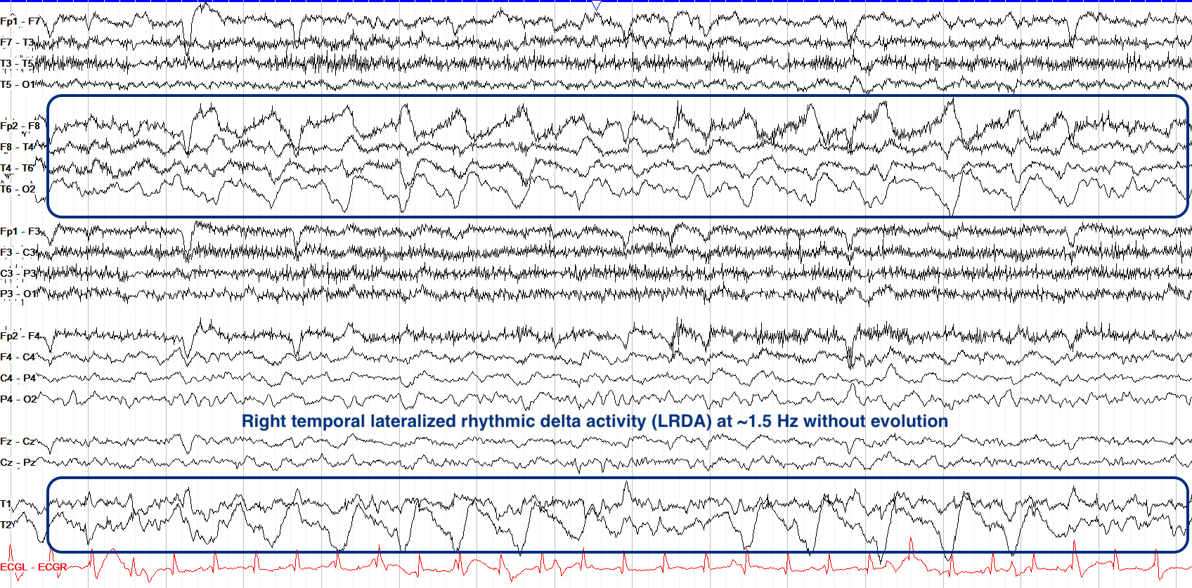 Right temporal lateralized rhythmic delta activity (LRDA) at ~1.5 Hz without evolution