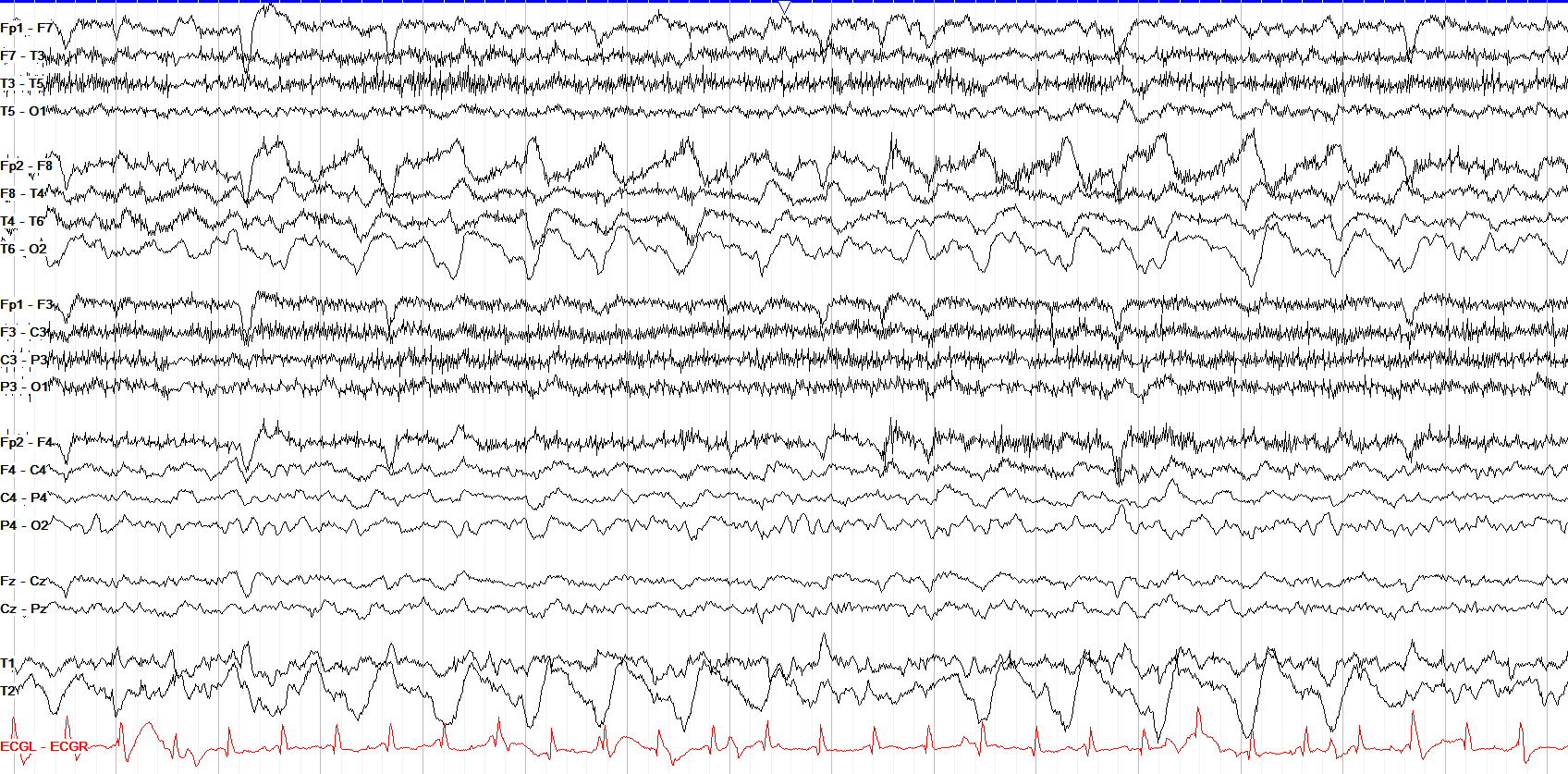 Right temporal LRDA at 1.5 Hz