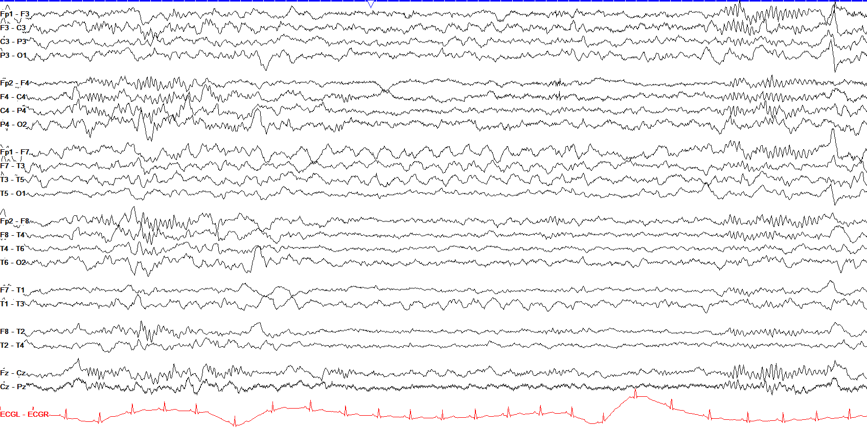 Left temporal LRDA in sleep