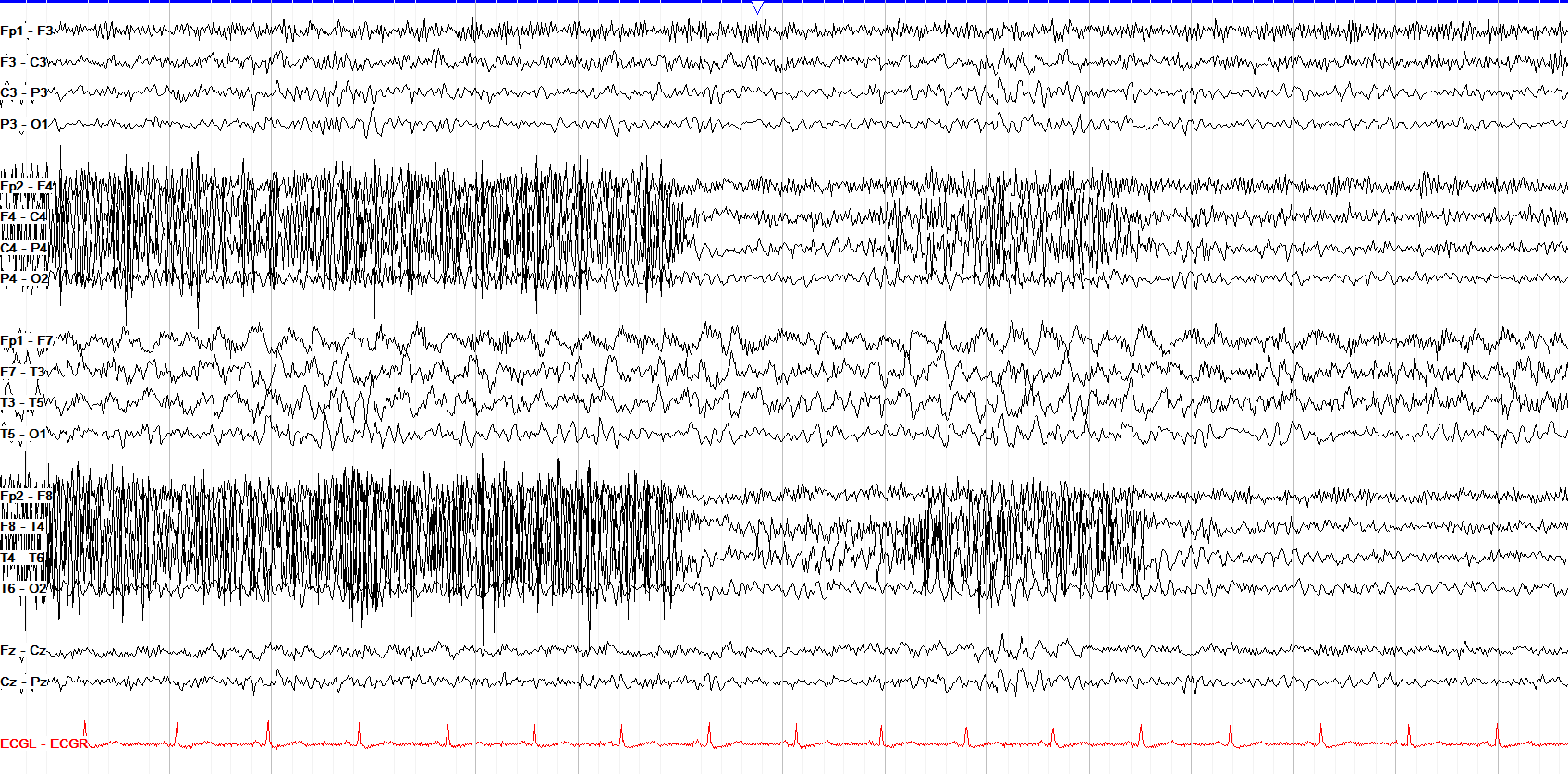 Left temporal LRDA