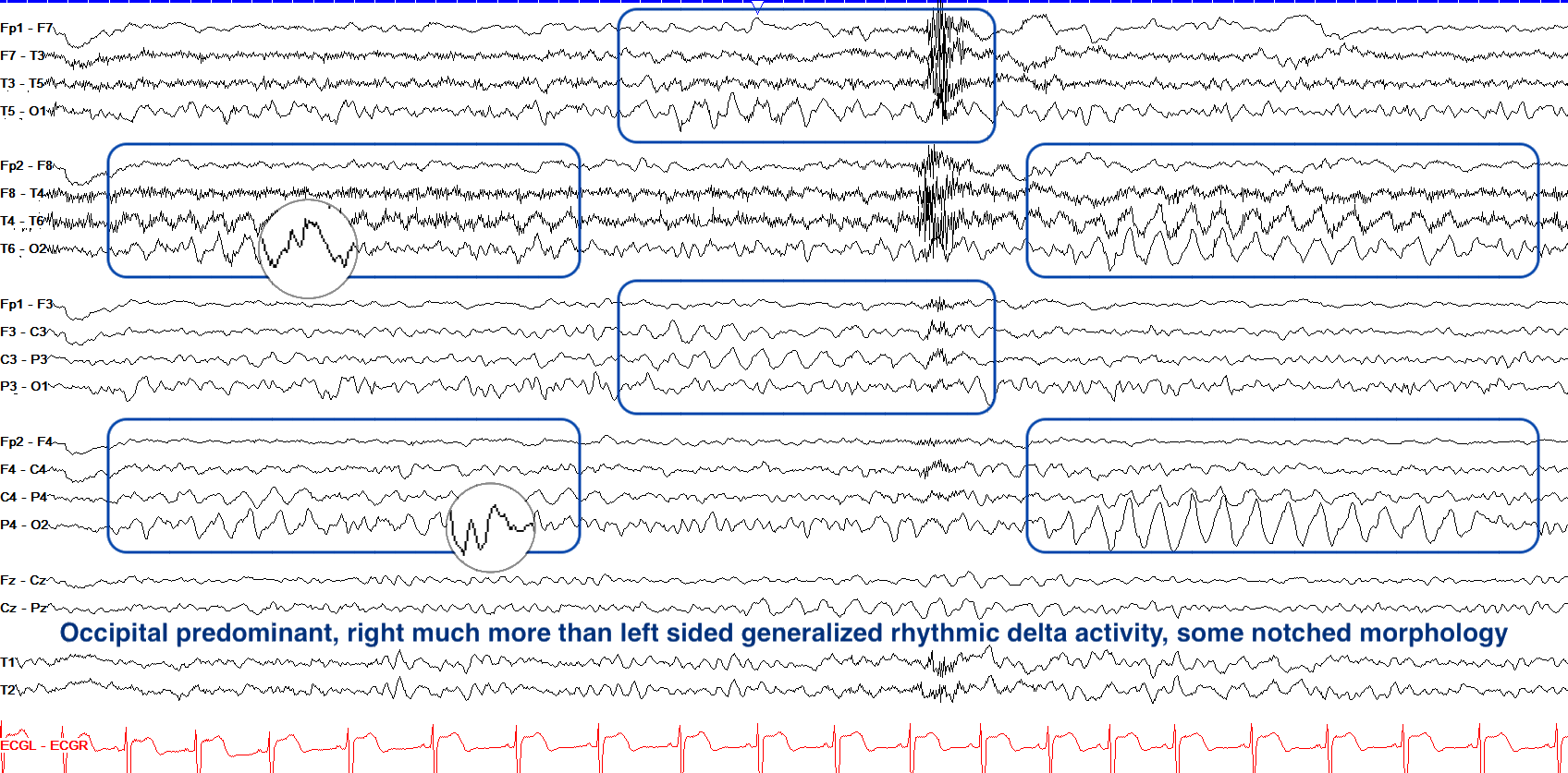 Right occipital predominant generalized rhythmic delta activity with notched morphology