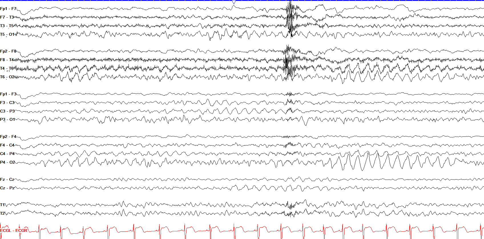 Occipital predominant generalized rhythmic delta activity