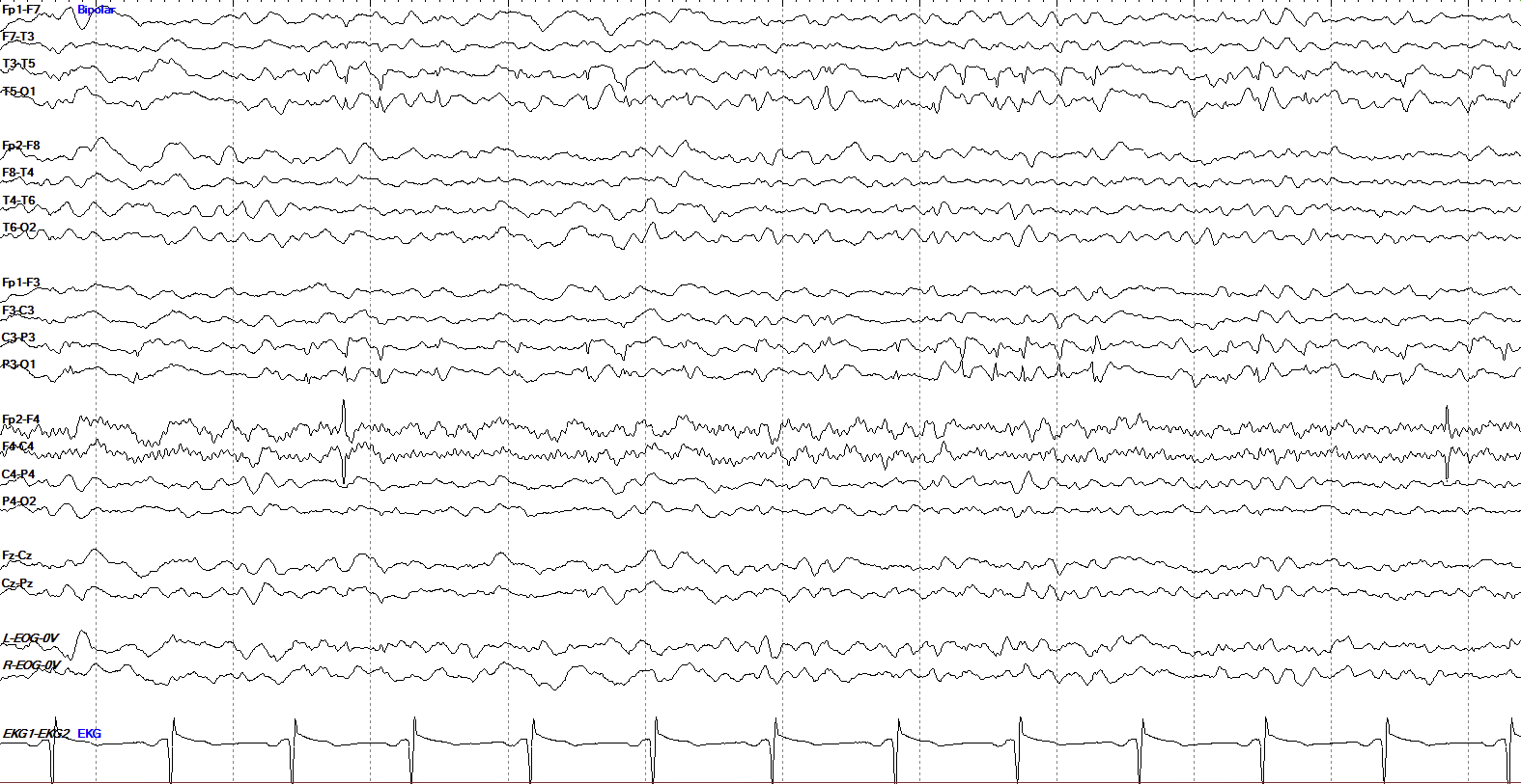 Possible BIRDs in the left temporo-parietal region