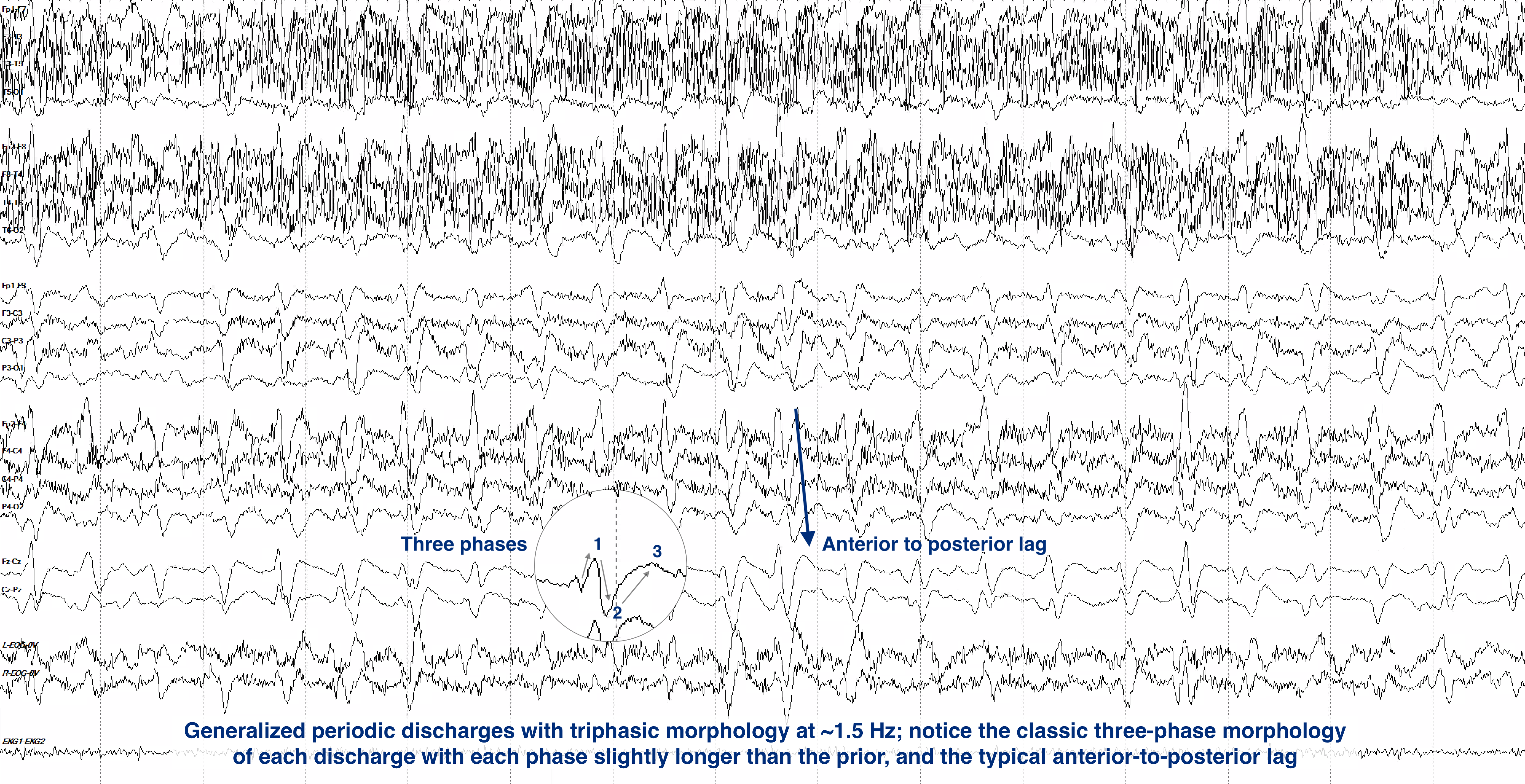 Generalized periodic discharges with triphasic morphology at ~1.5 Hz