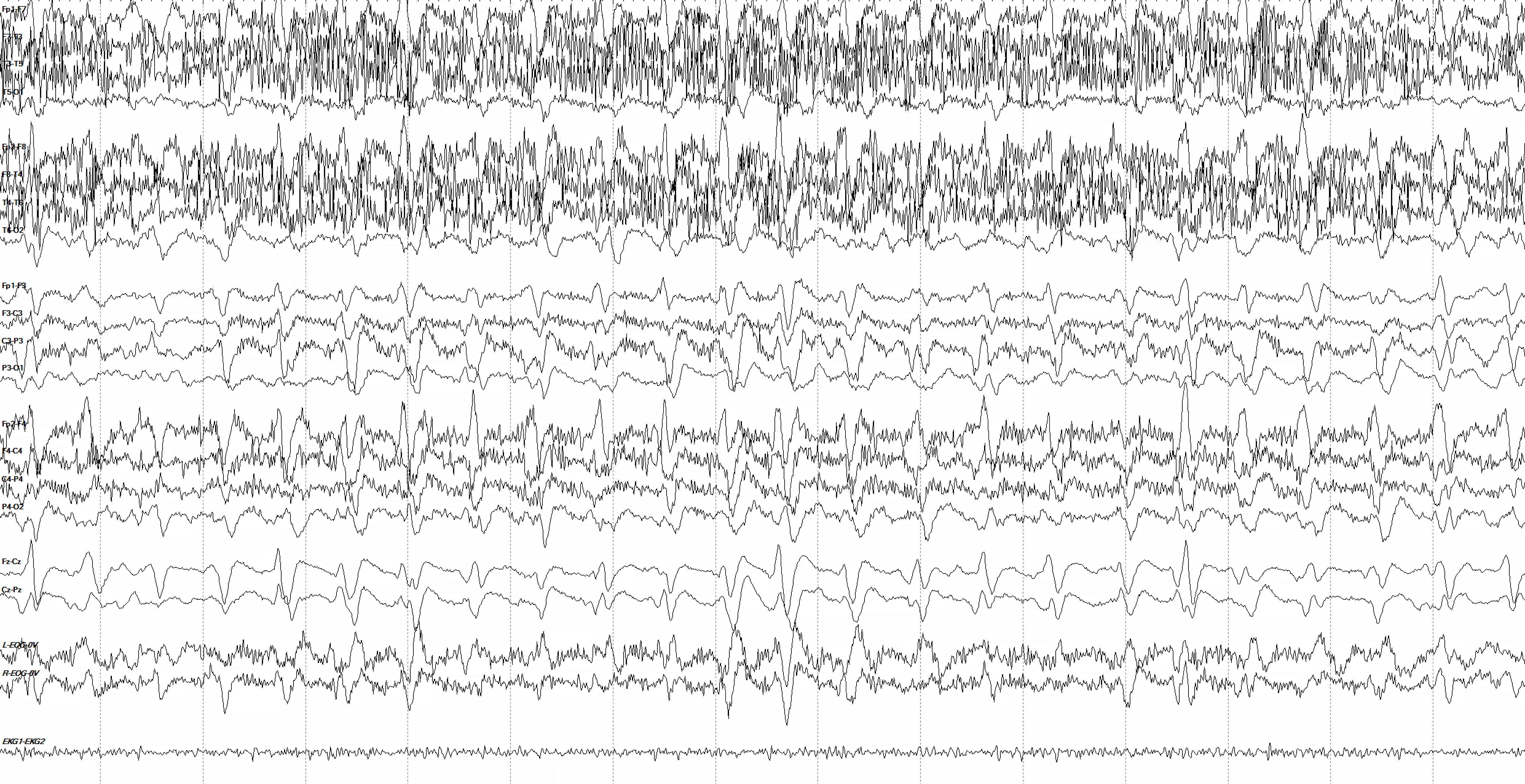 GPDs with triphasic morphology at ~1.5 Hz