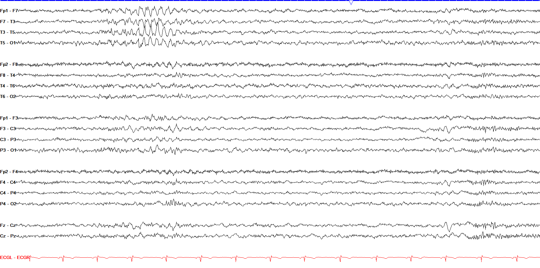 Left temporal wicket waves