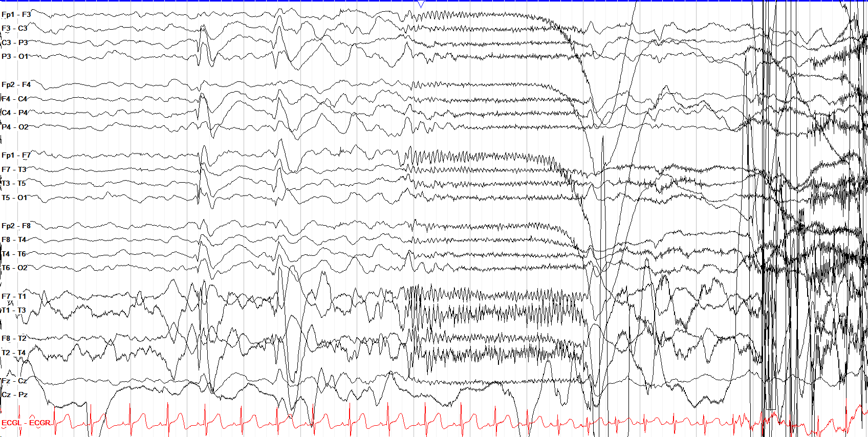 Test yourself - focal or generalized tonic?