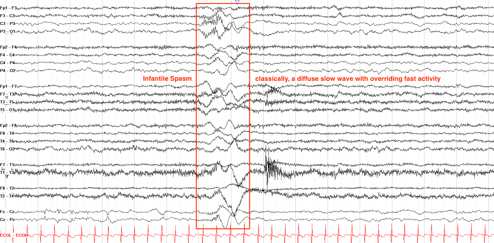Infantile spasm example