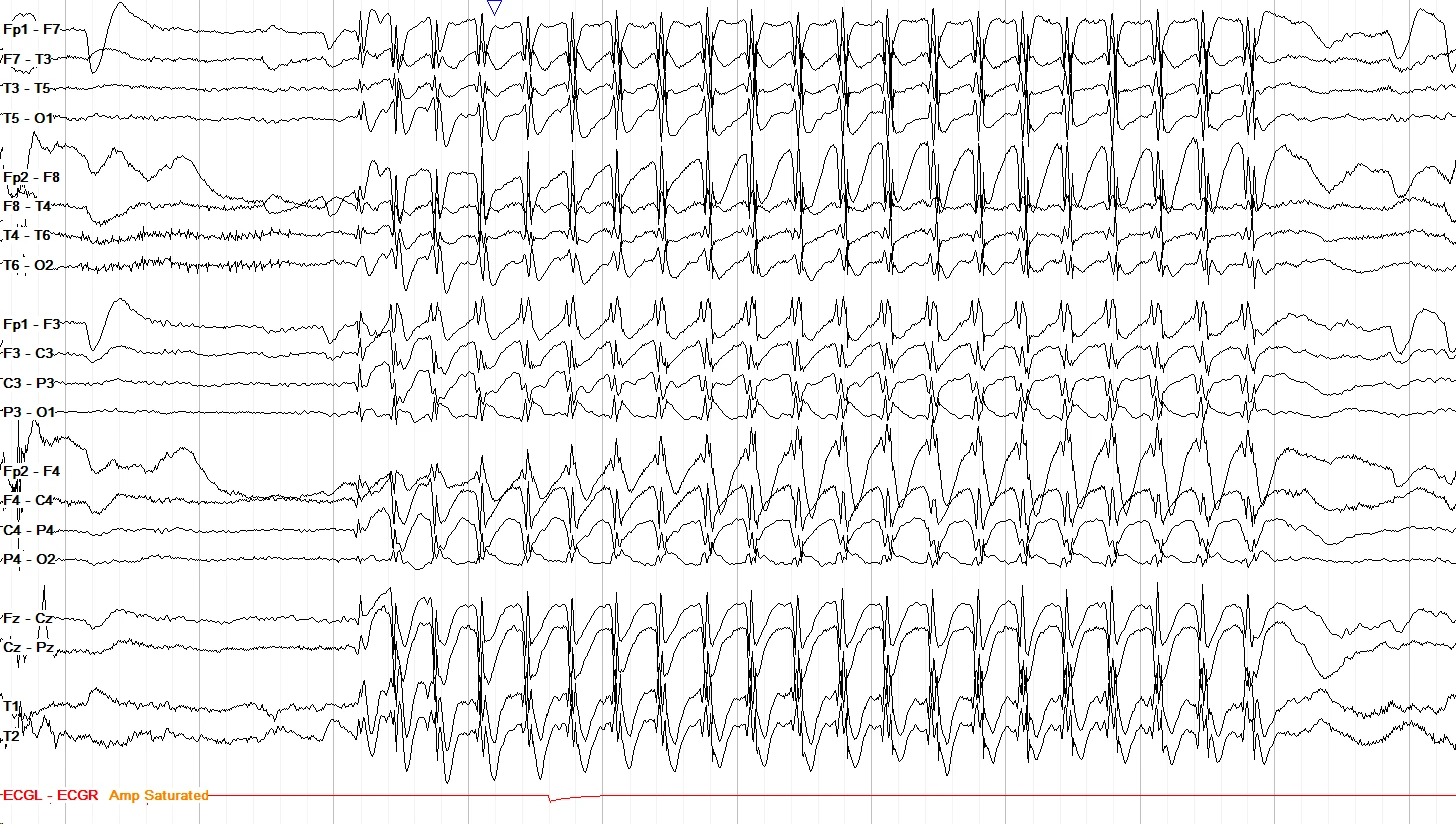 Typical absence seizure