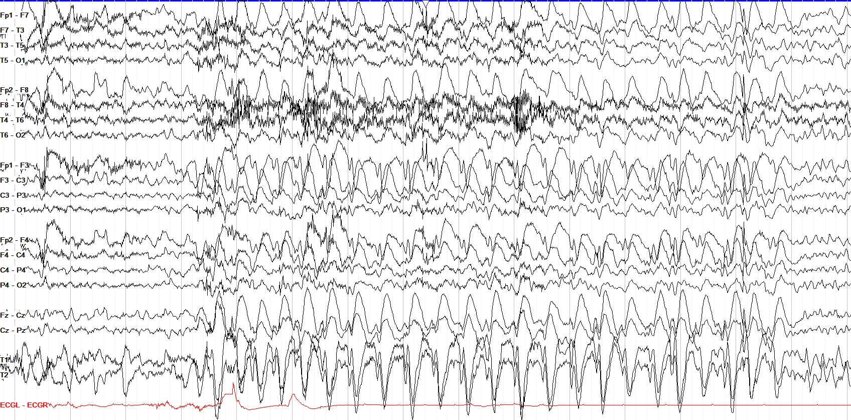 Generalized subclinical seizure