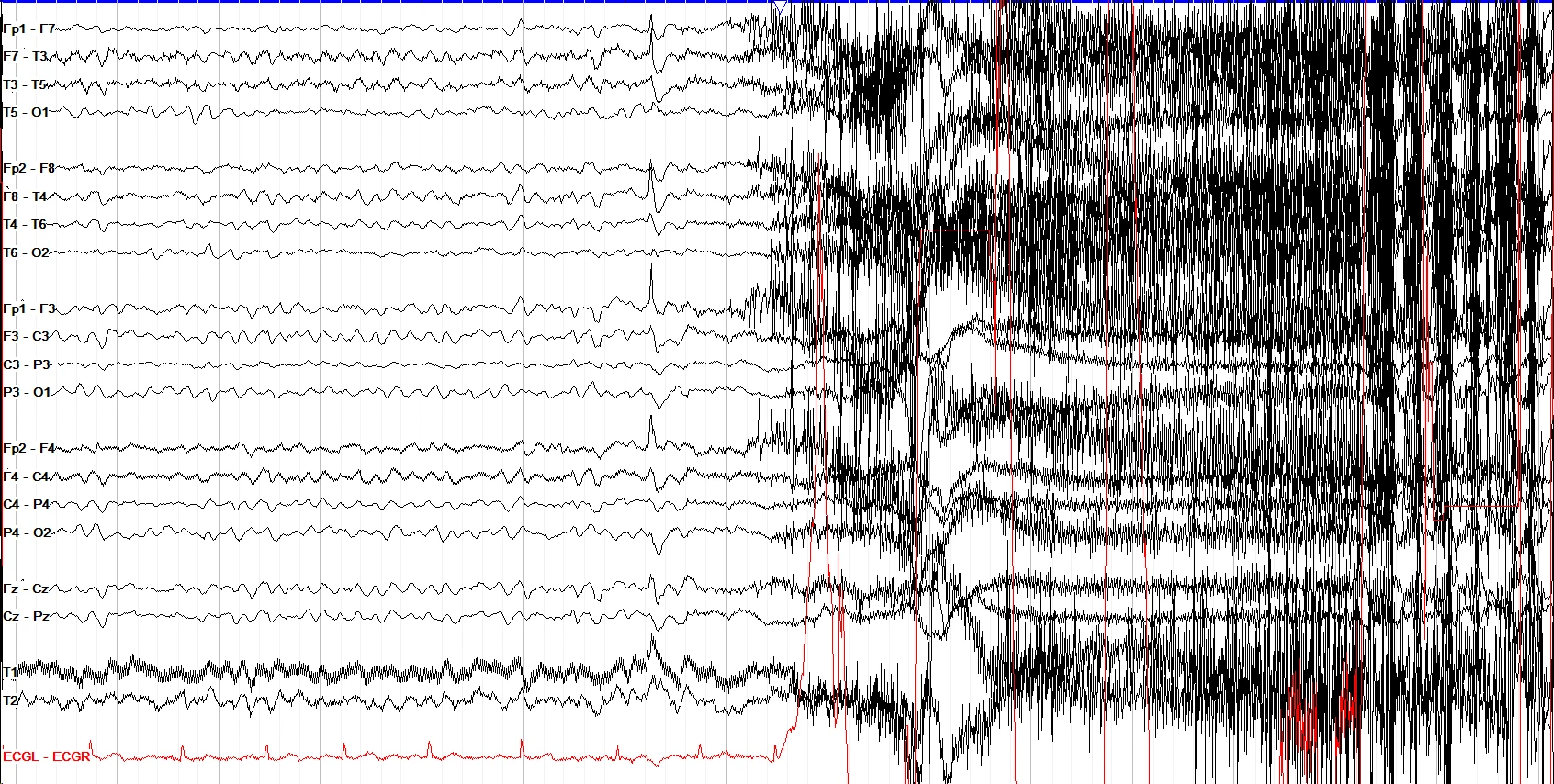 Generalized tonic clonic seizure