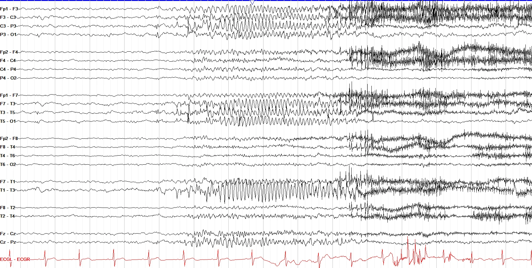 Left hemispheric, short focal seizure