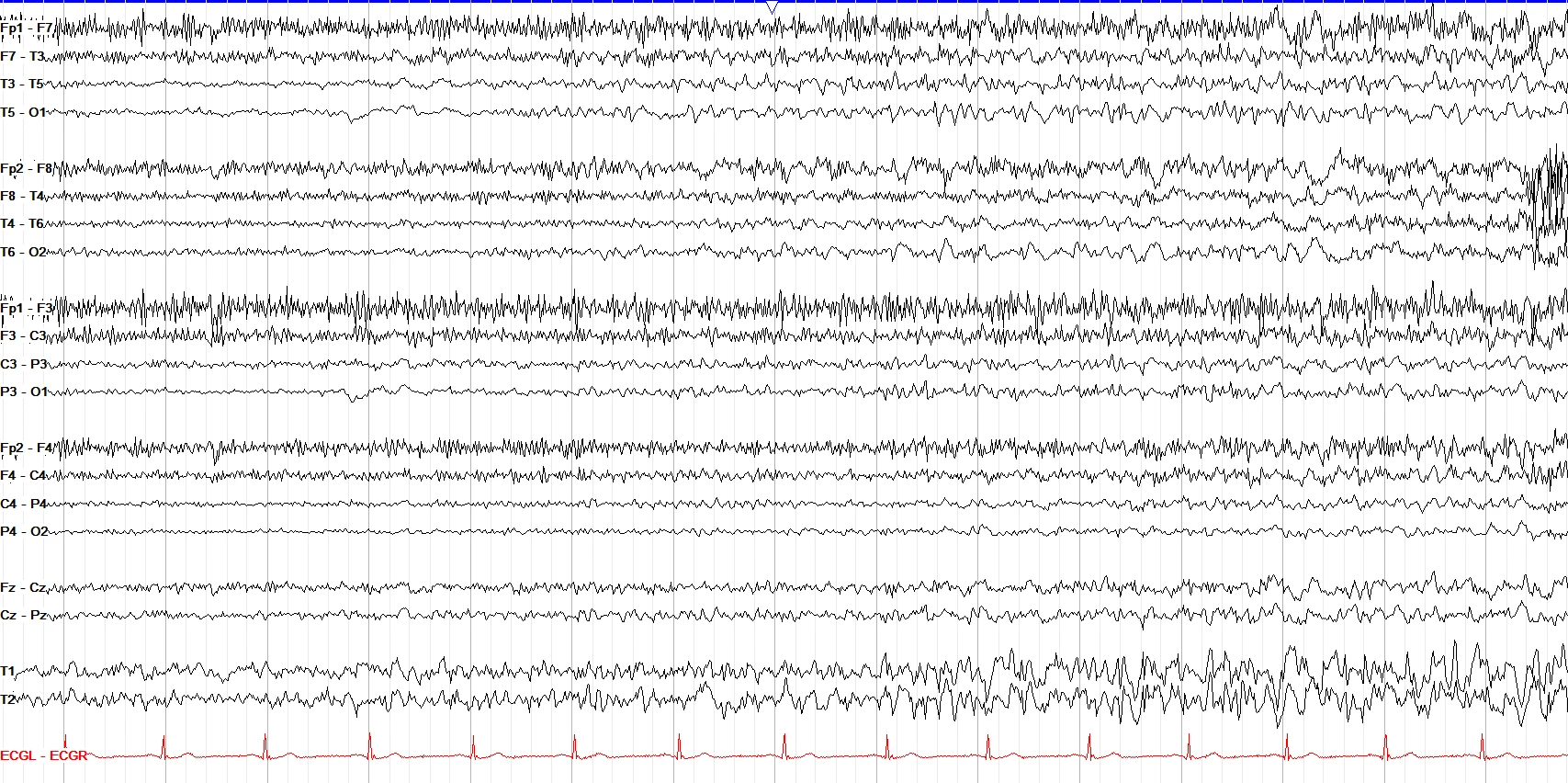 Left posterior quadrant onset seizure