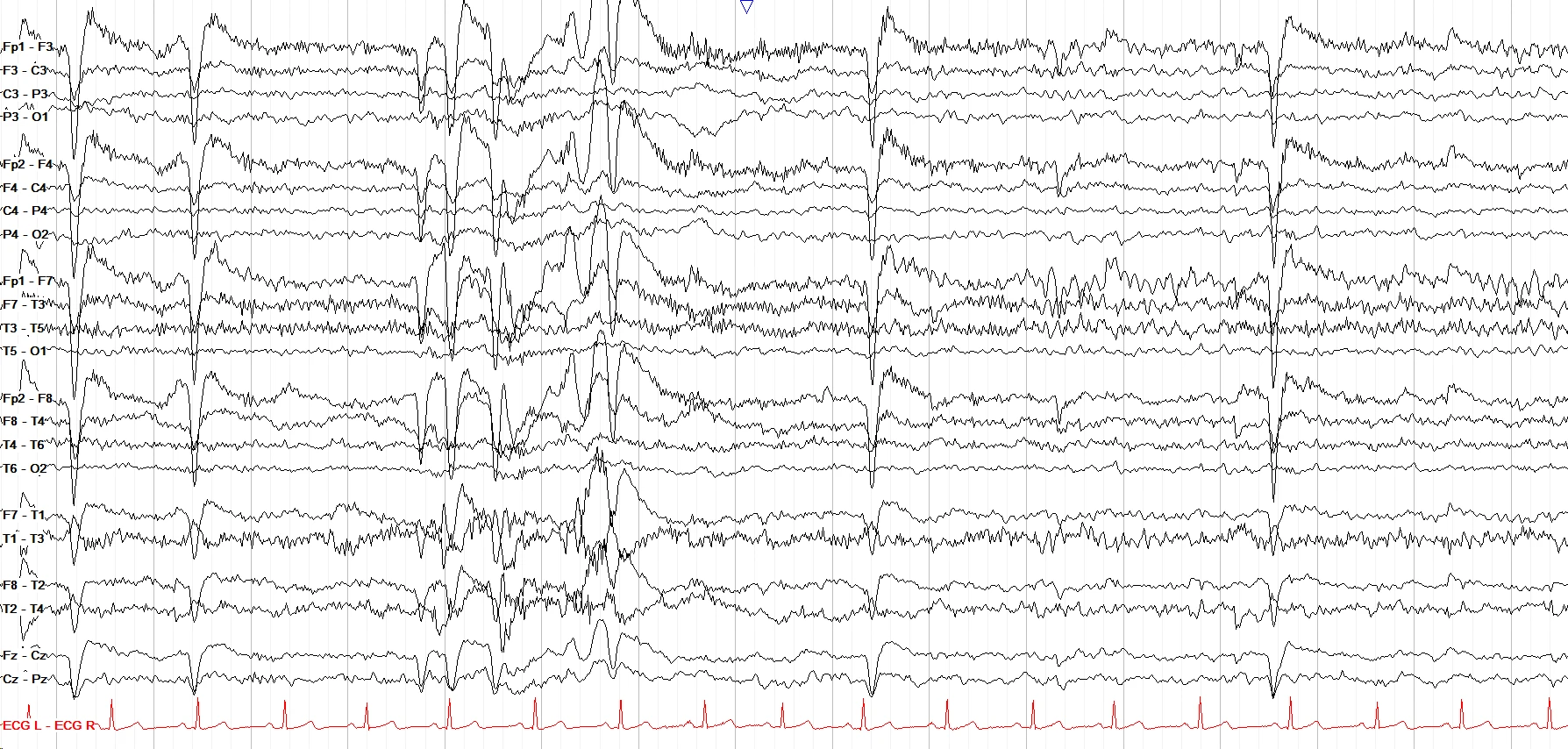 Left temporal focal seizure