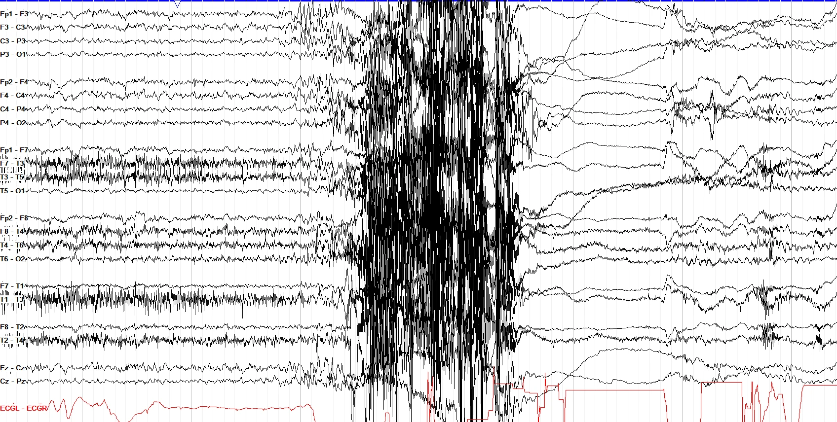 Myoclonic seizure